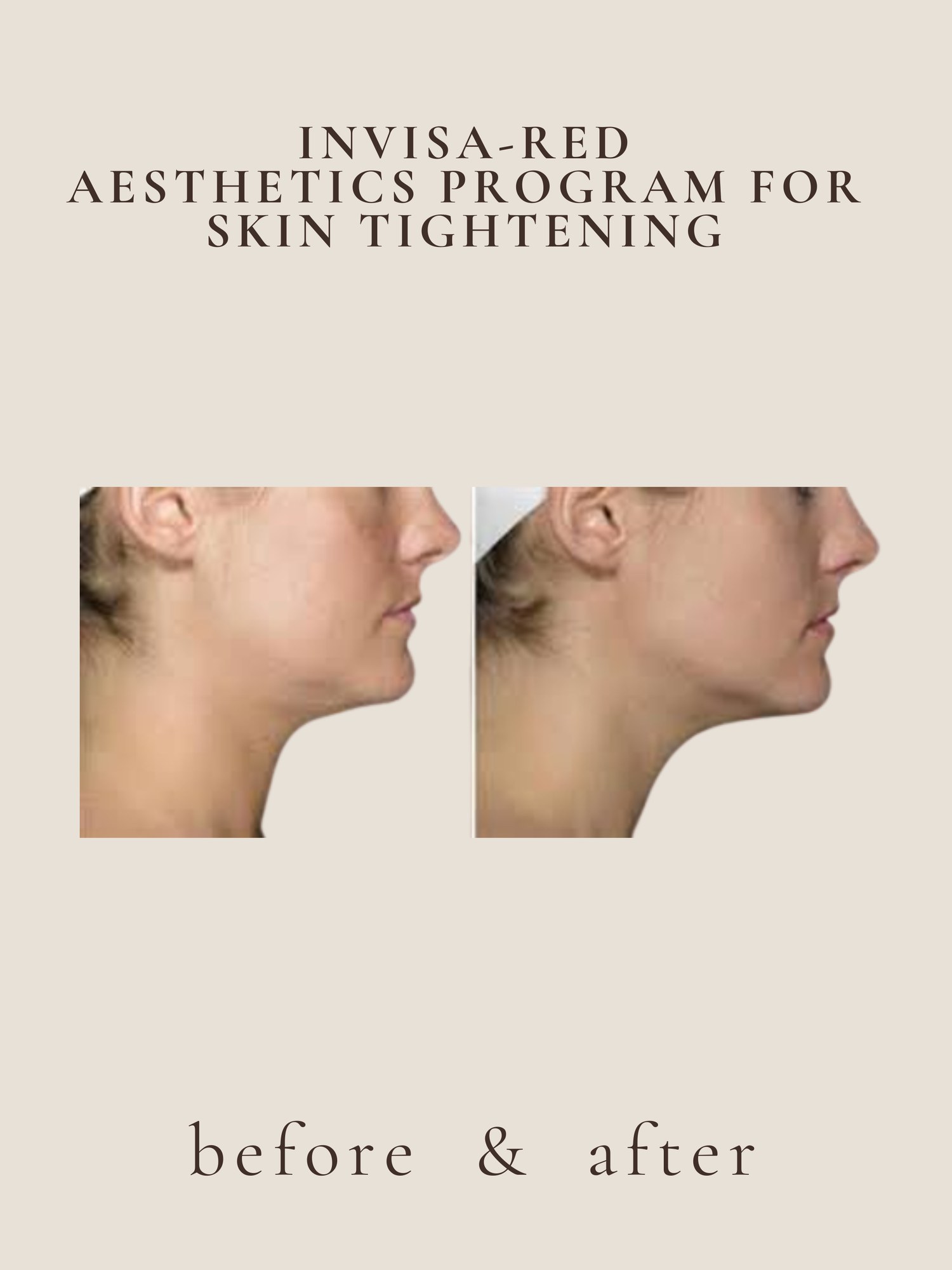 Body Contouring — Invisa-RED® Aesthetics