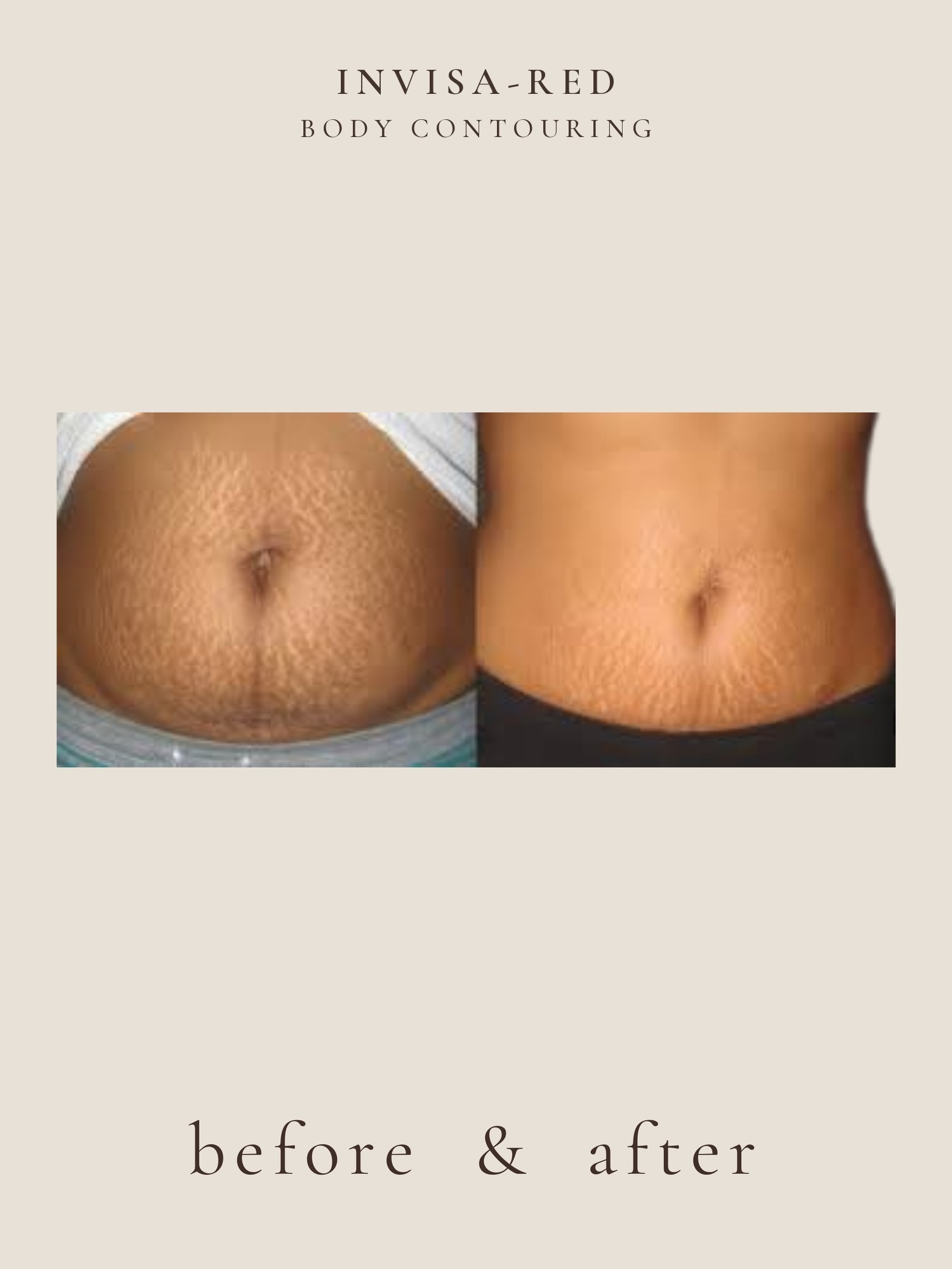 Body Contouring — Invisa-RED® Aesthetics
