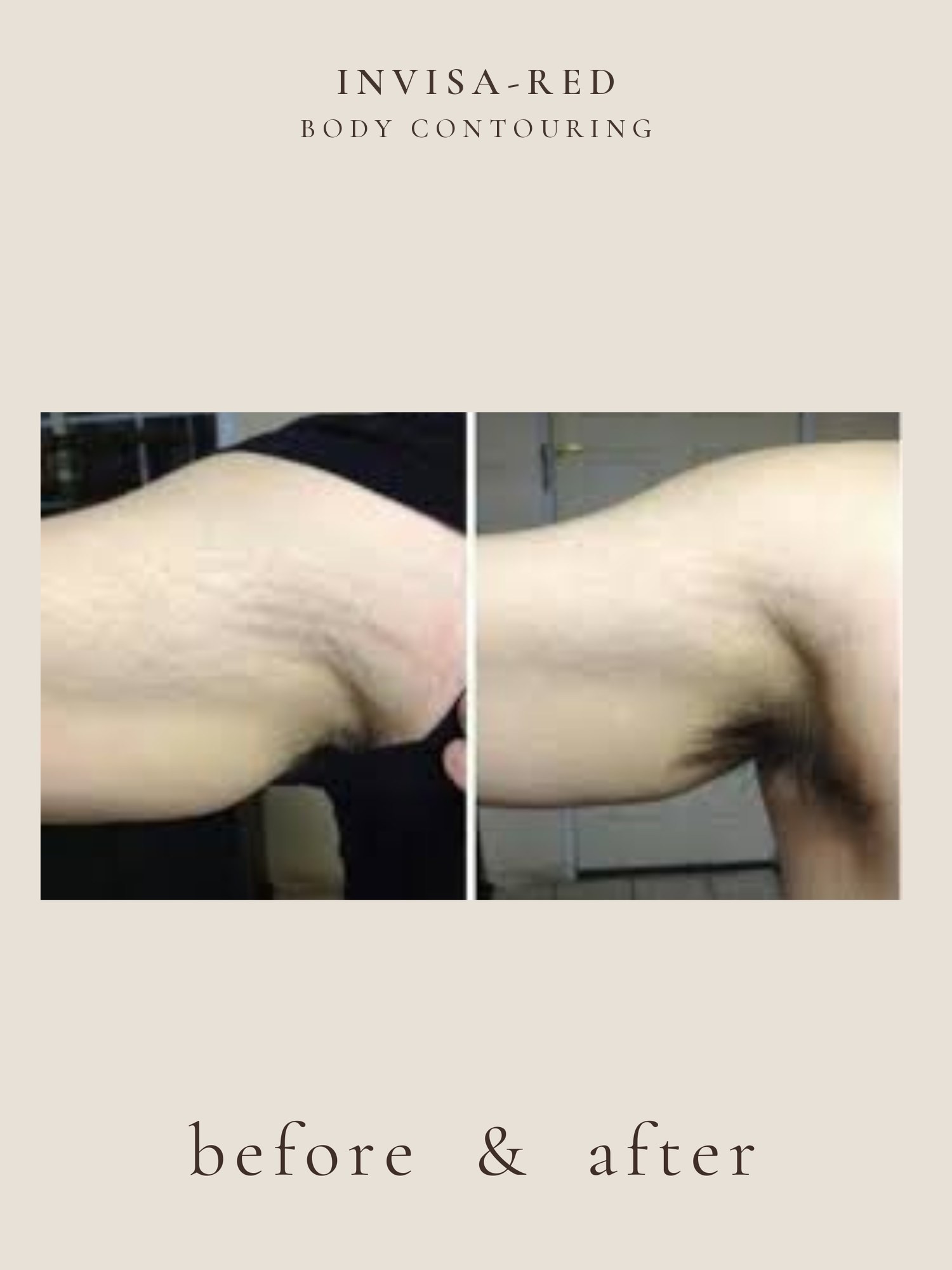 Body Contouring — Invisa-RED® Aesthetics