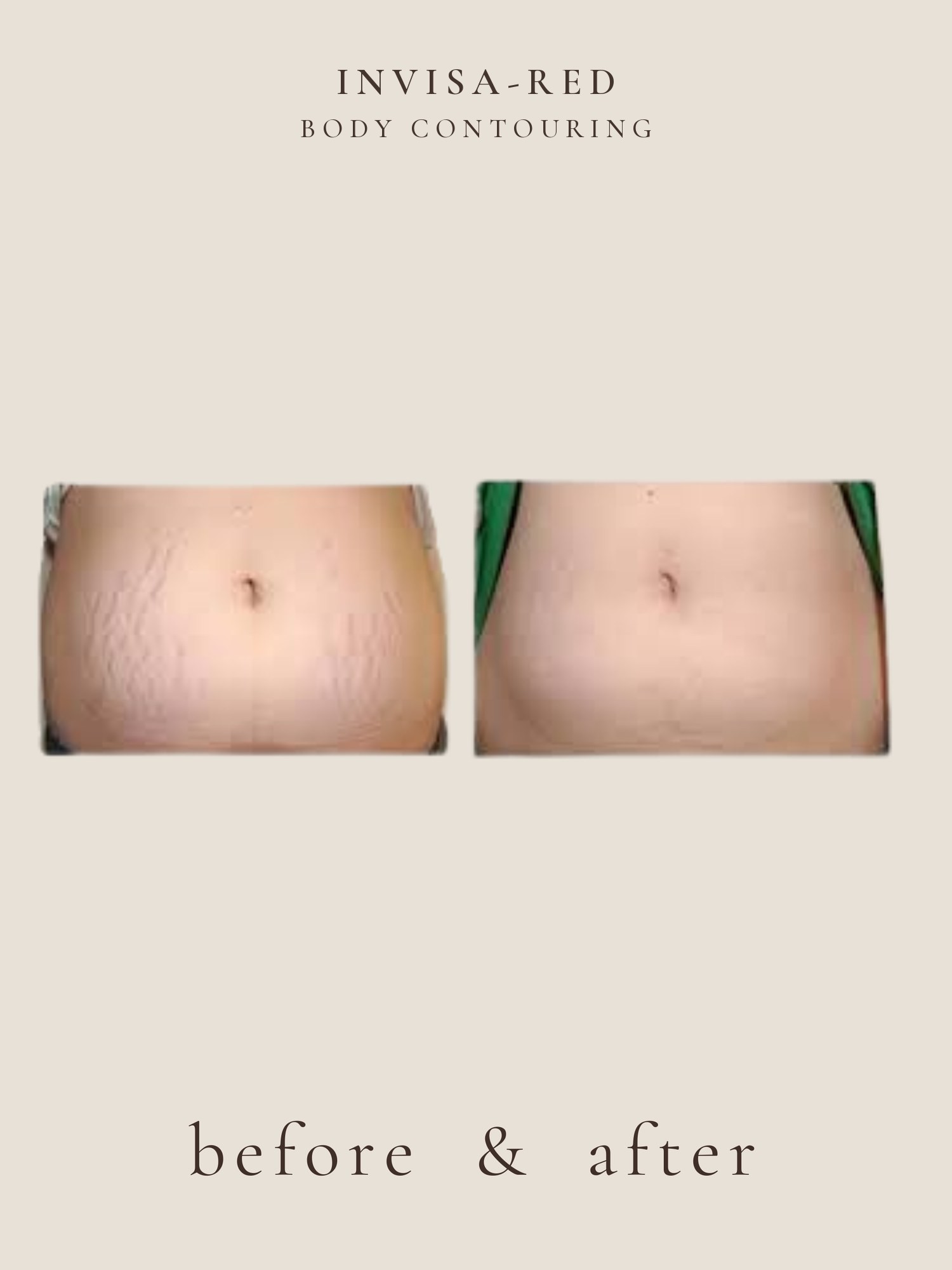 Body Contouring — Invisa-RED® Aesthetics