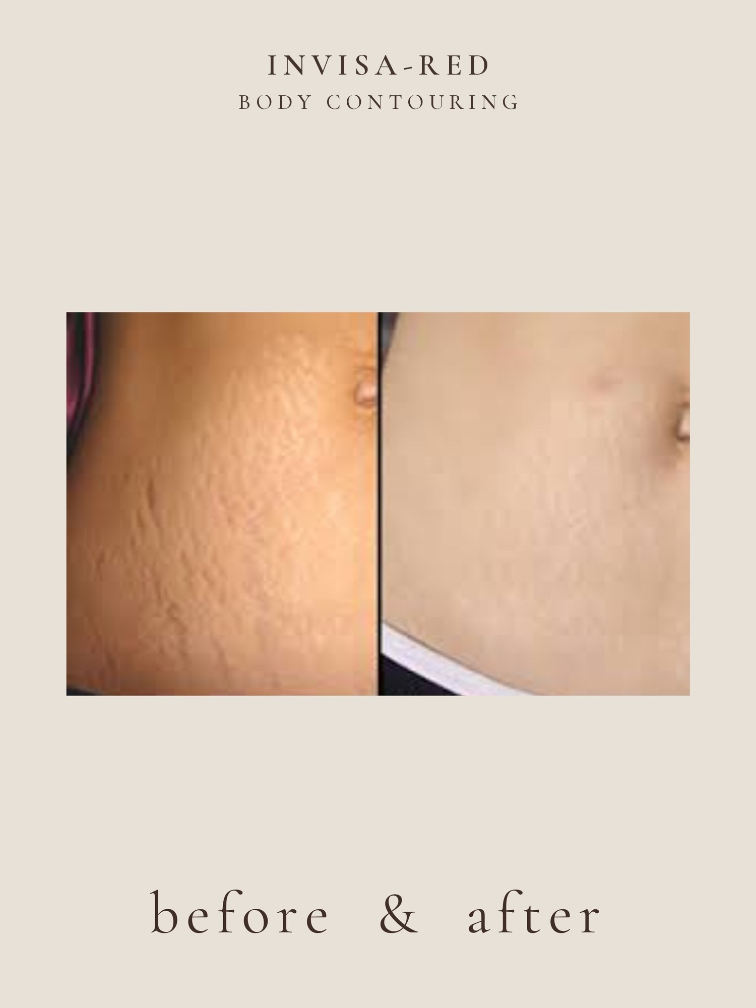 Body Contouring — Invisa-RED® Aesthetics