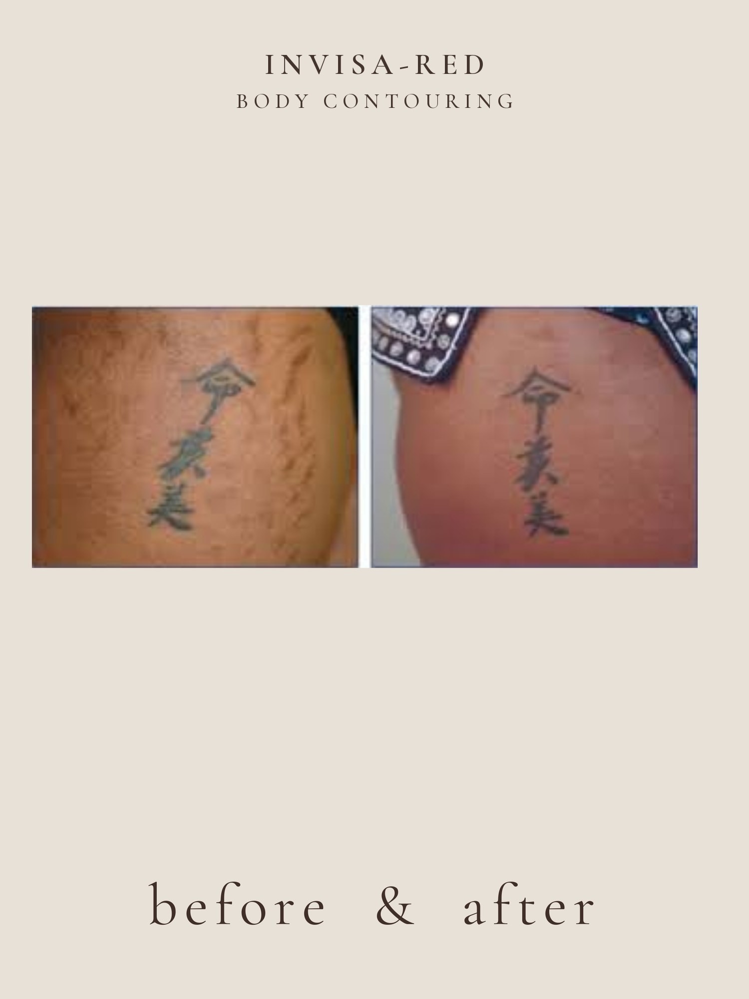Body Contouring — Invisa-RED® Aesthetics