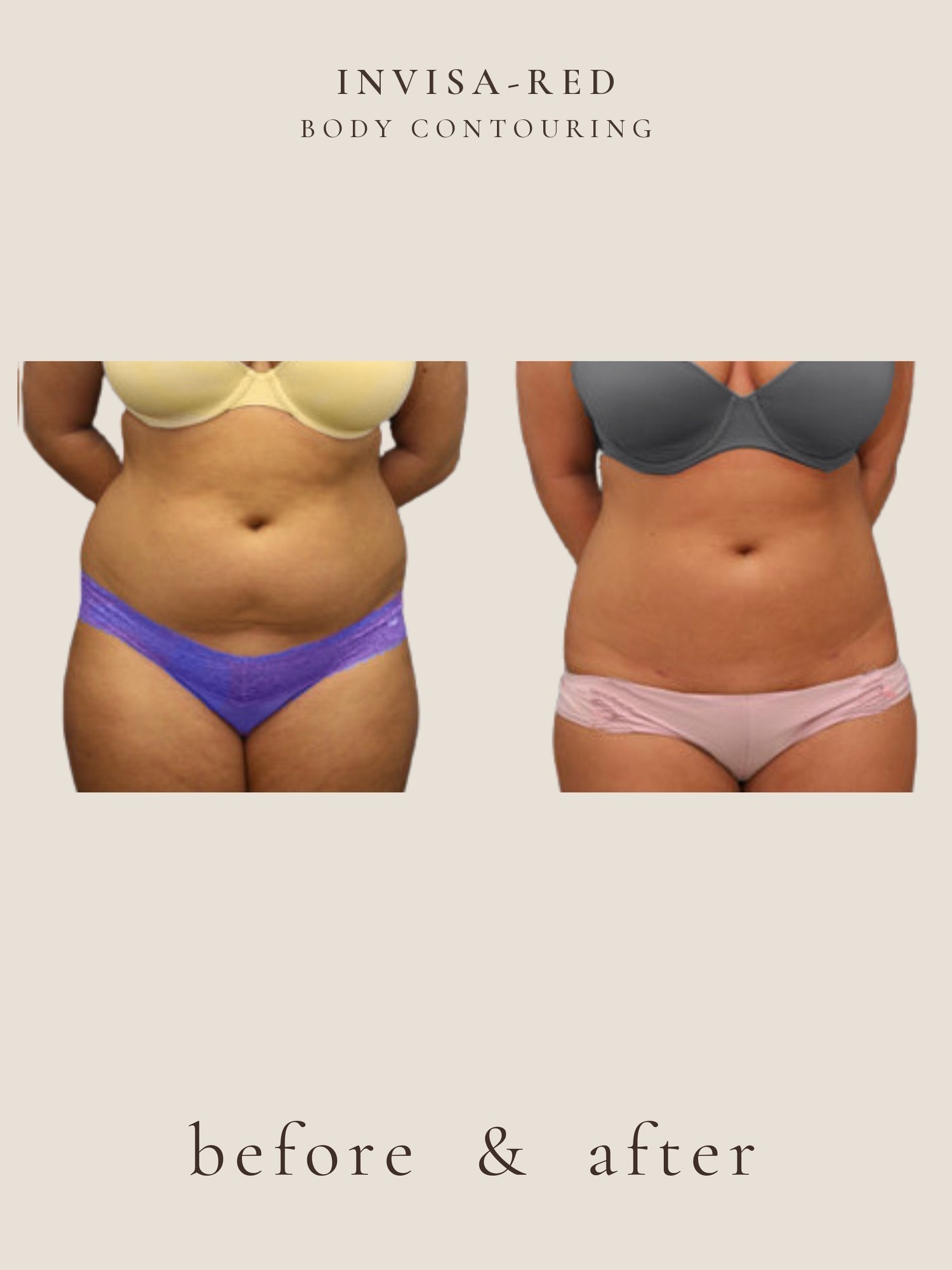 Body Contouring — Invisa-RED® Aesthetics