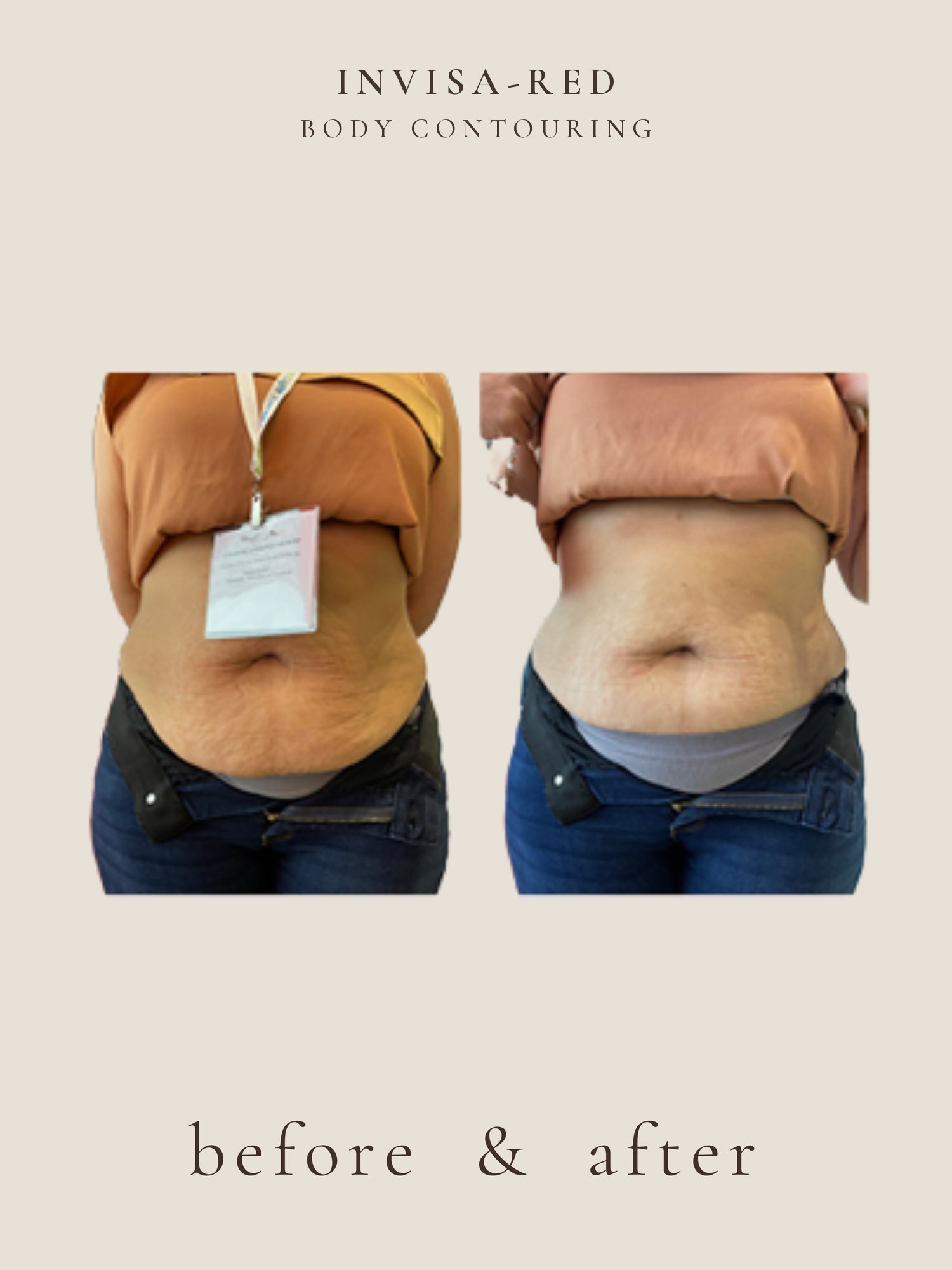 Body Contouring — Invisa-RED® Aesthetics