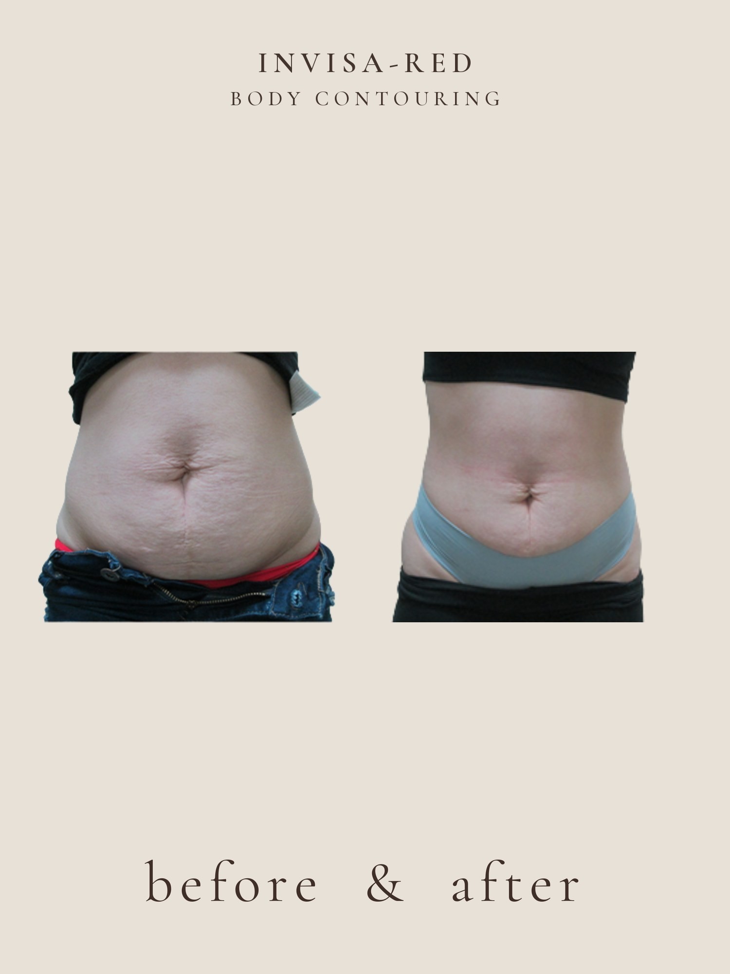 Body Contouring — Invisa-RED® Aesthetics