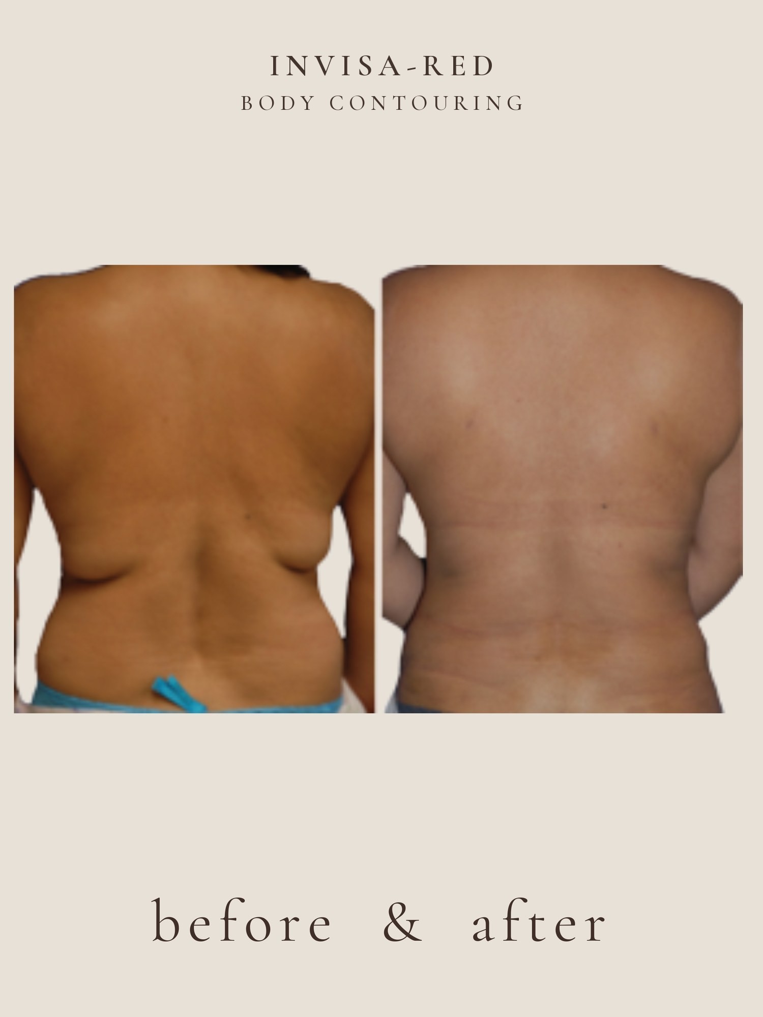 Body Contouring — Invisa-RED® Aesthetics