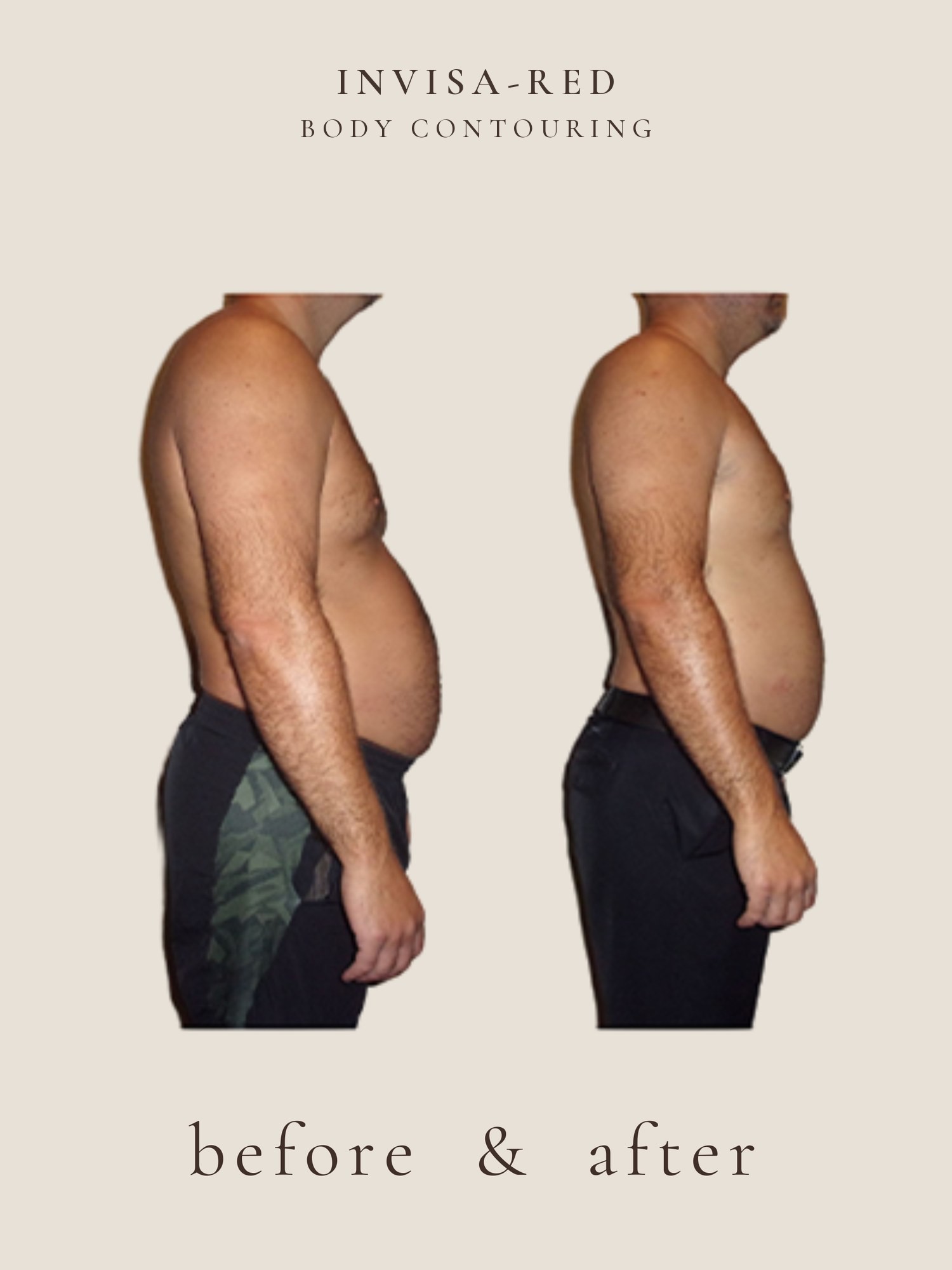 Body contouring before and after