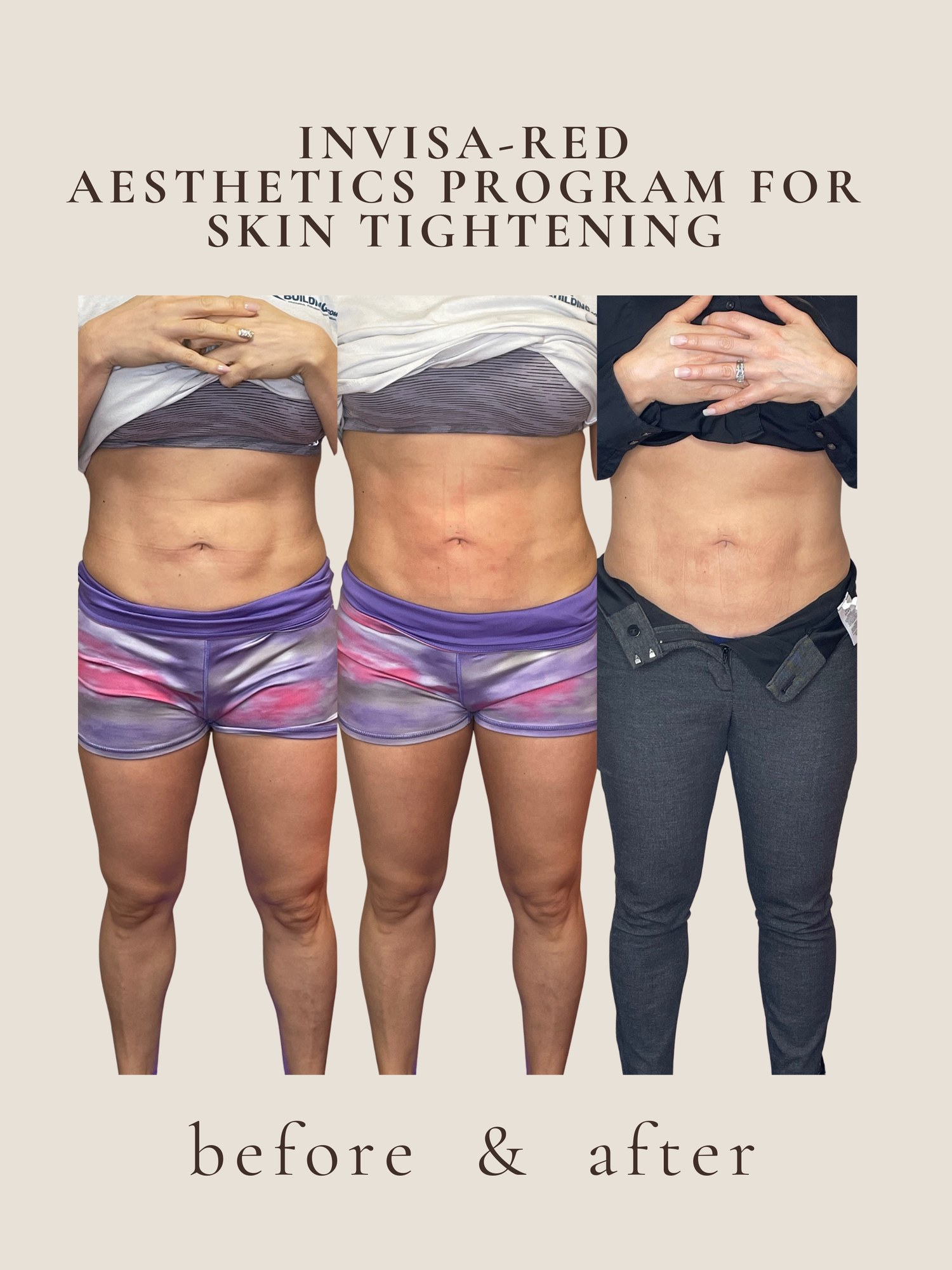 invisa-RED® skin tightening before and after