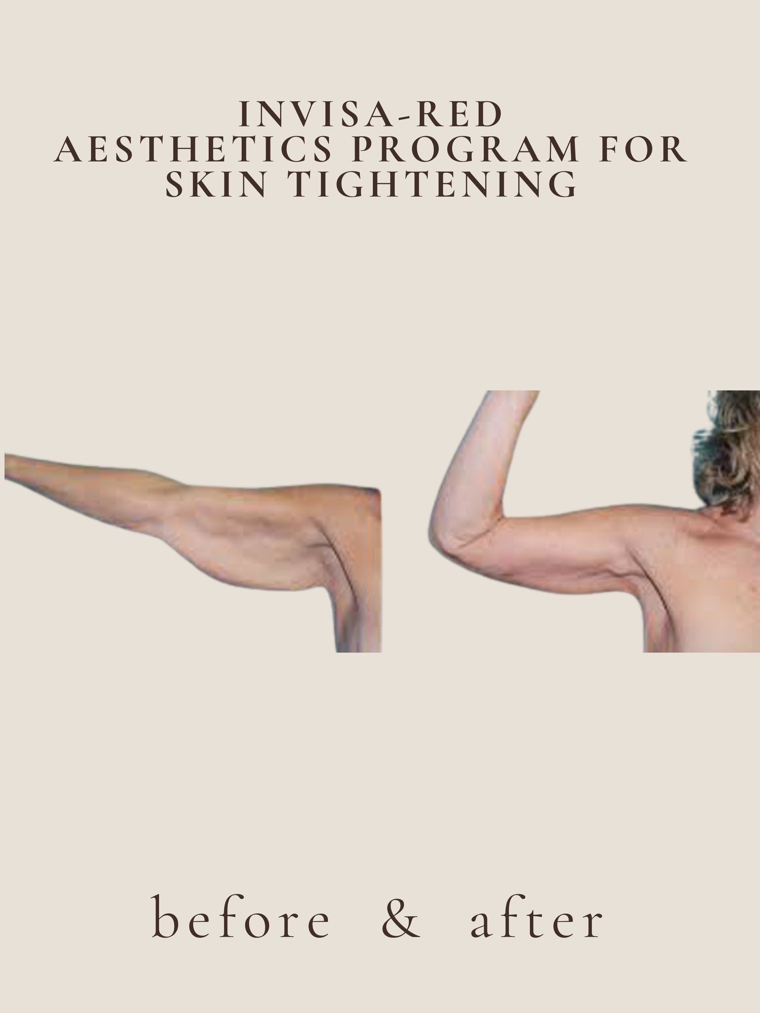 Skin Tightening — Invisa-RED® Aesthetics