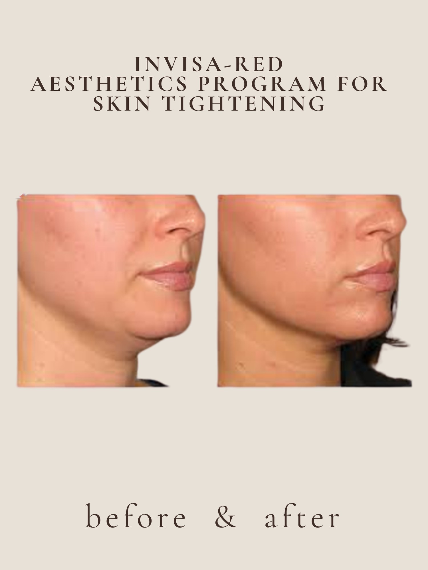 Post weight loss skin tightening result at Awakened Skin