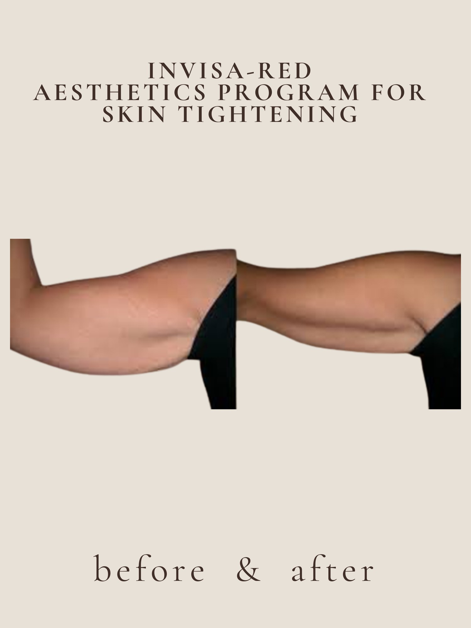 Skin Tightening — Invisa-RED® Aesthetics