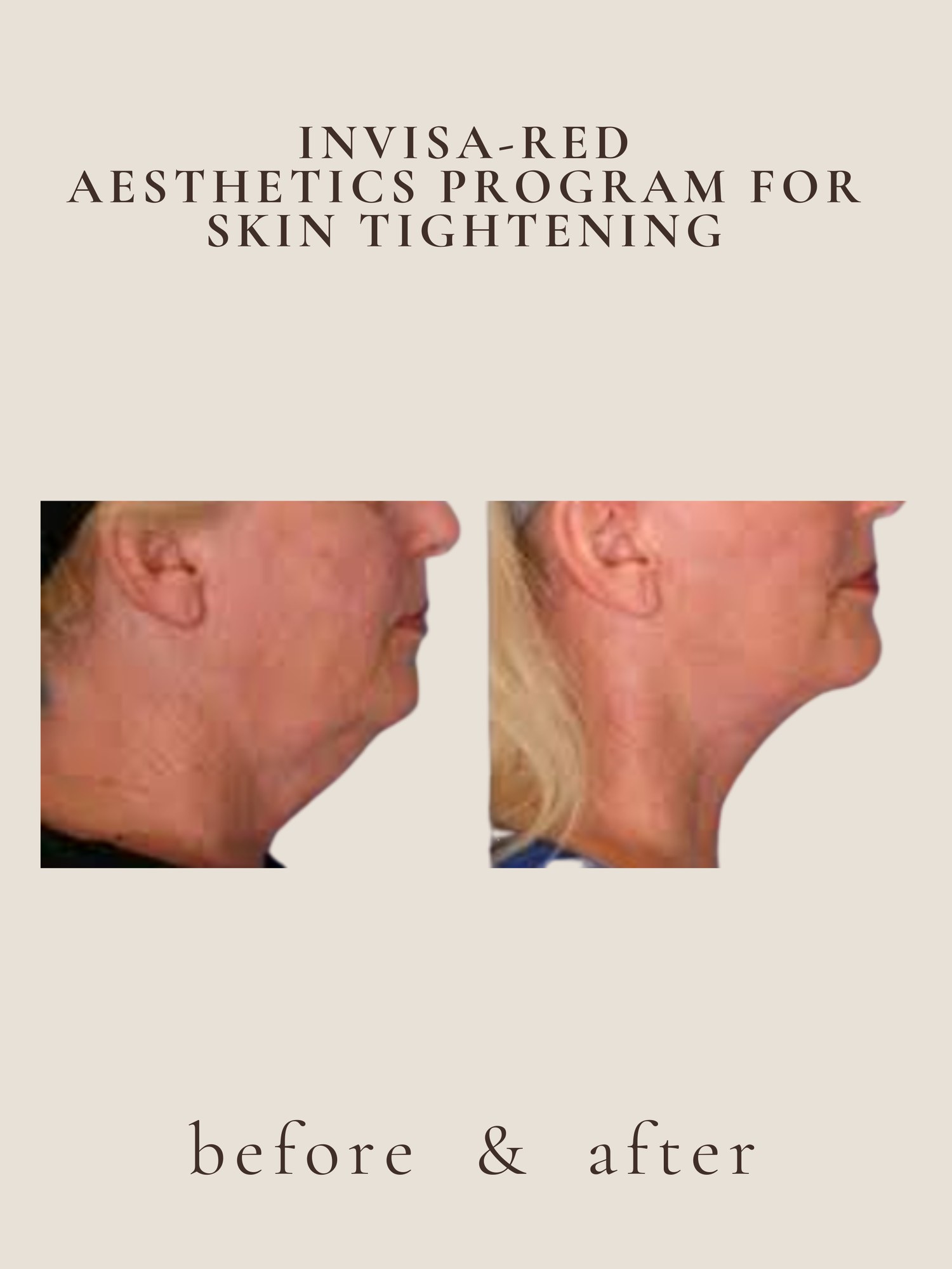 Skin Tightening — Invisa-RED® Aesthetics