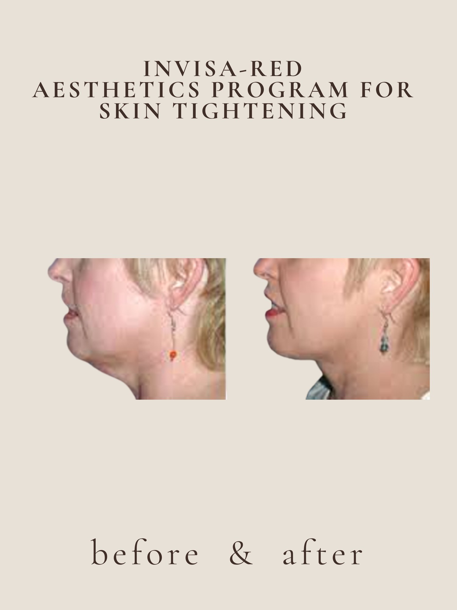 Skin Tightening — Invisa-RED® Aesthetics