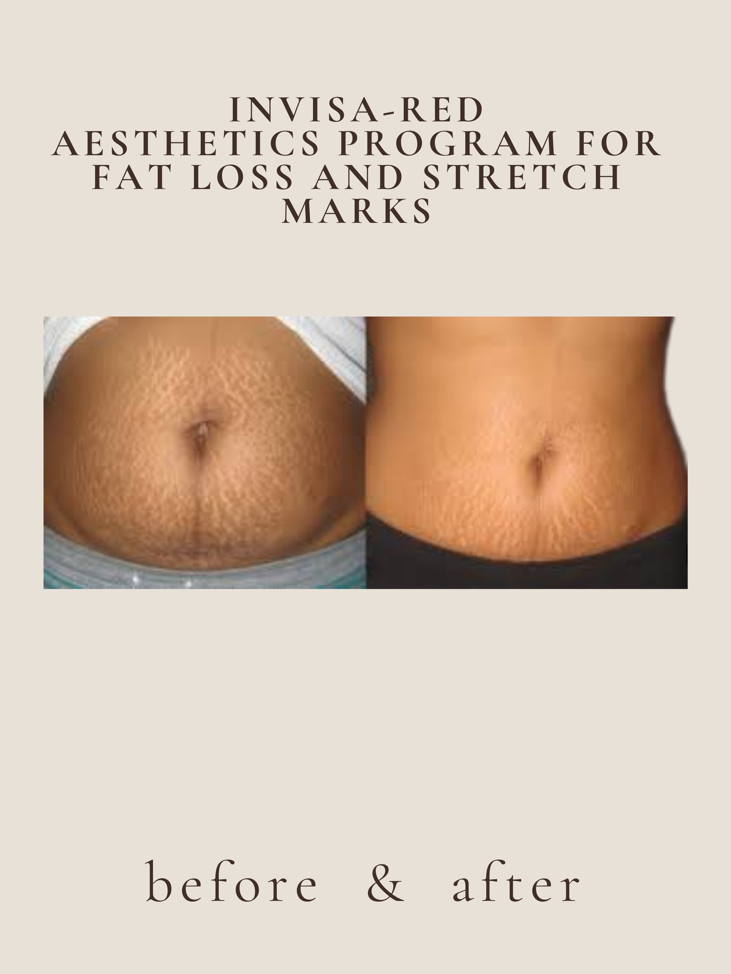 invisa-RED® stretch marks before and after