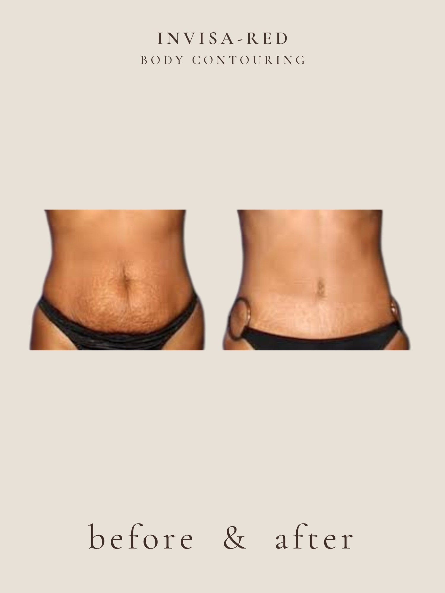 Stretch Marks — Invisa-RED® Aesthetics