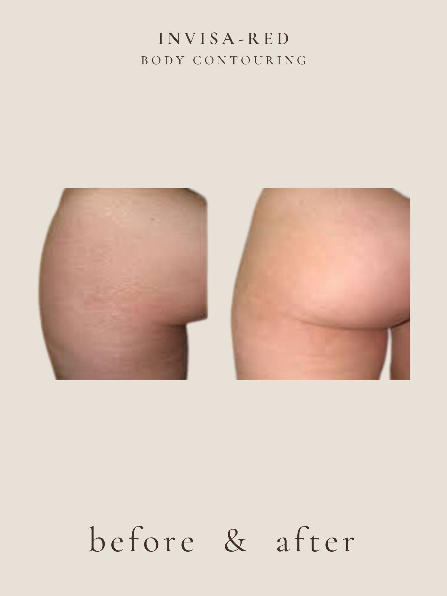 Stretch Marks — Invisa-RED® Aesthetics