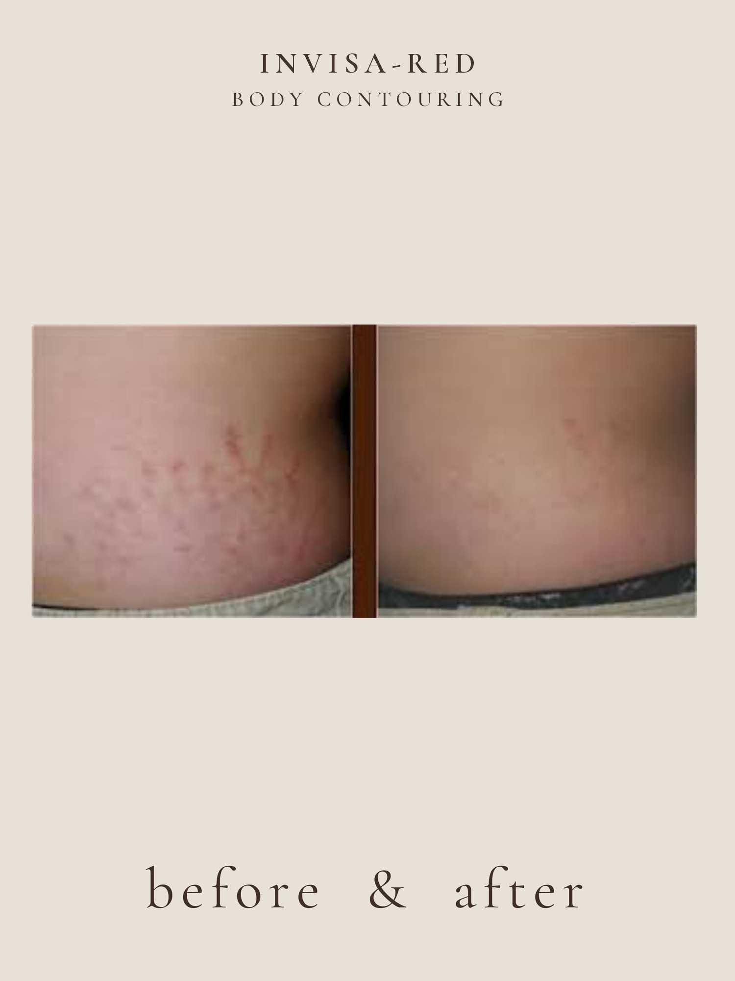 Stretch Marks — Invisa-RED® Aesthetics