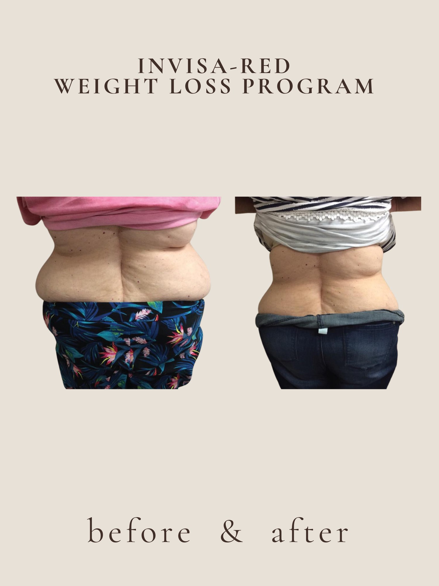 Post weight loss body restoration with invisa-RED® and plasma at Awakened Skin