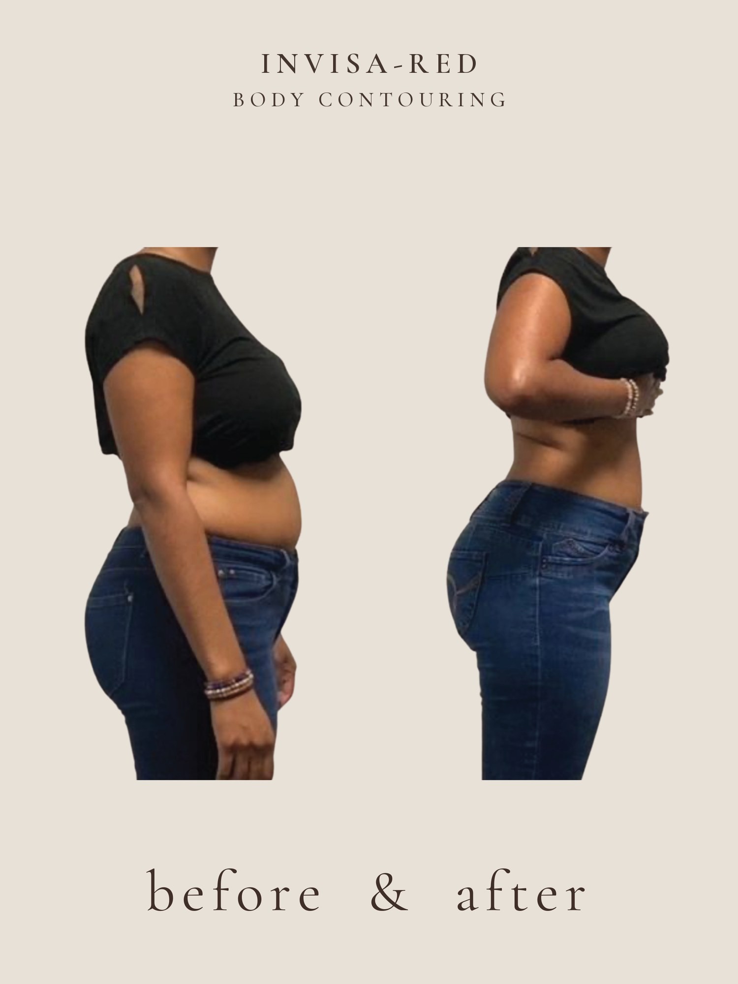 Body contouring before and after