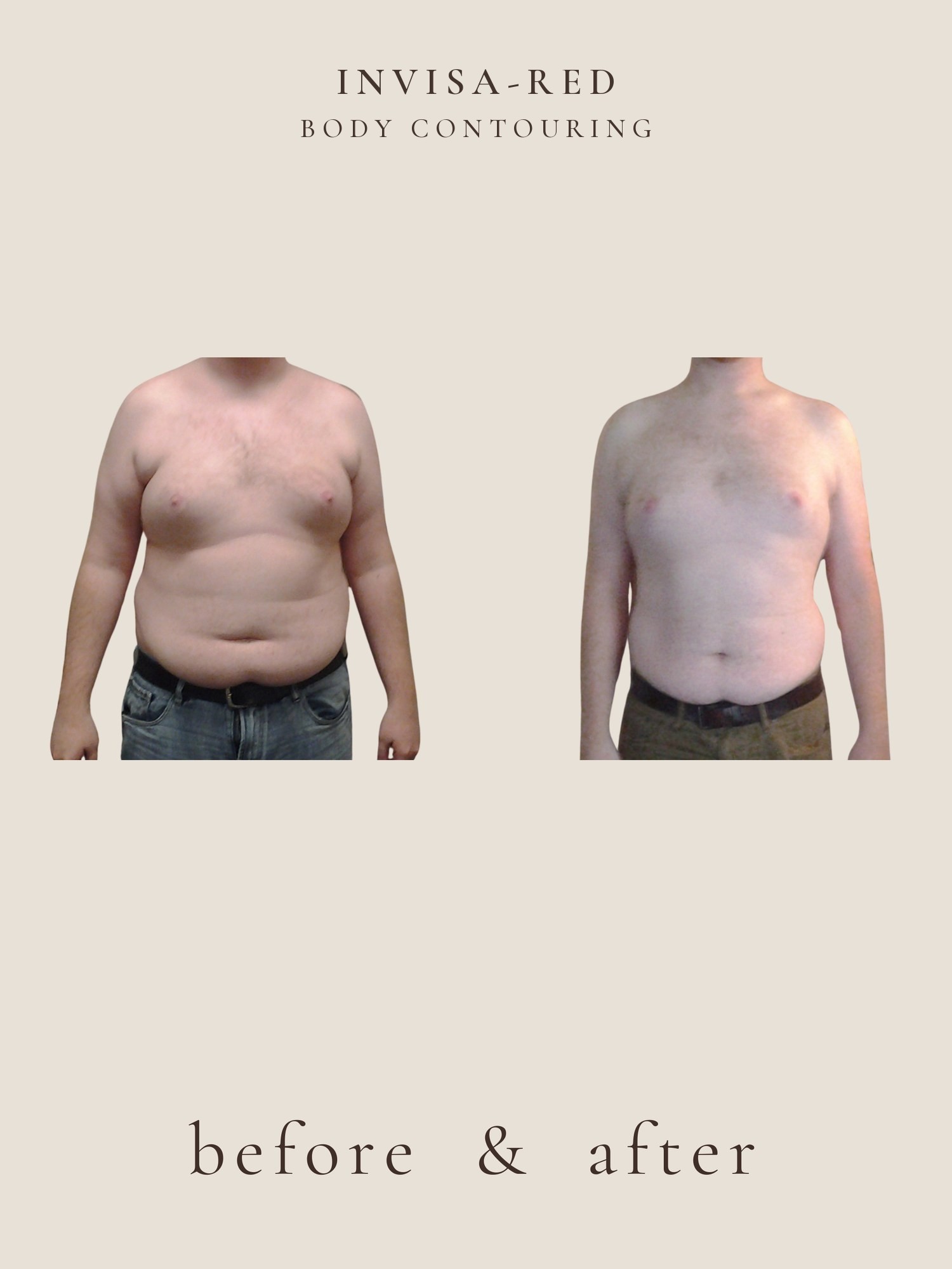 Fat Loss — Light & Laser