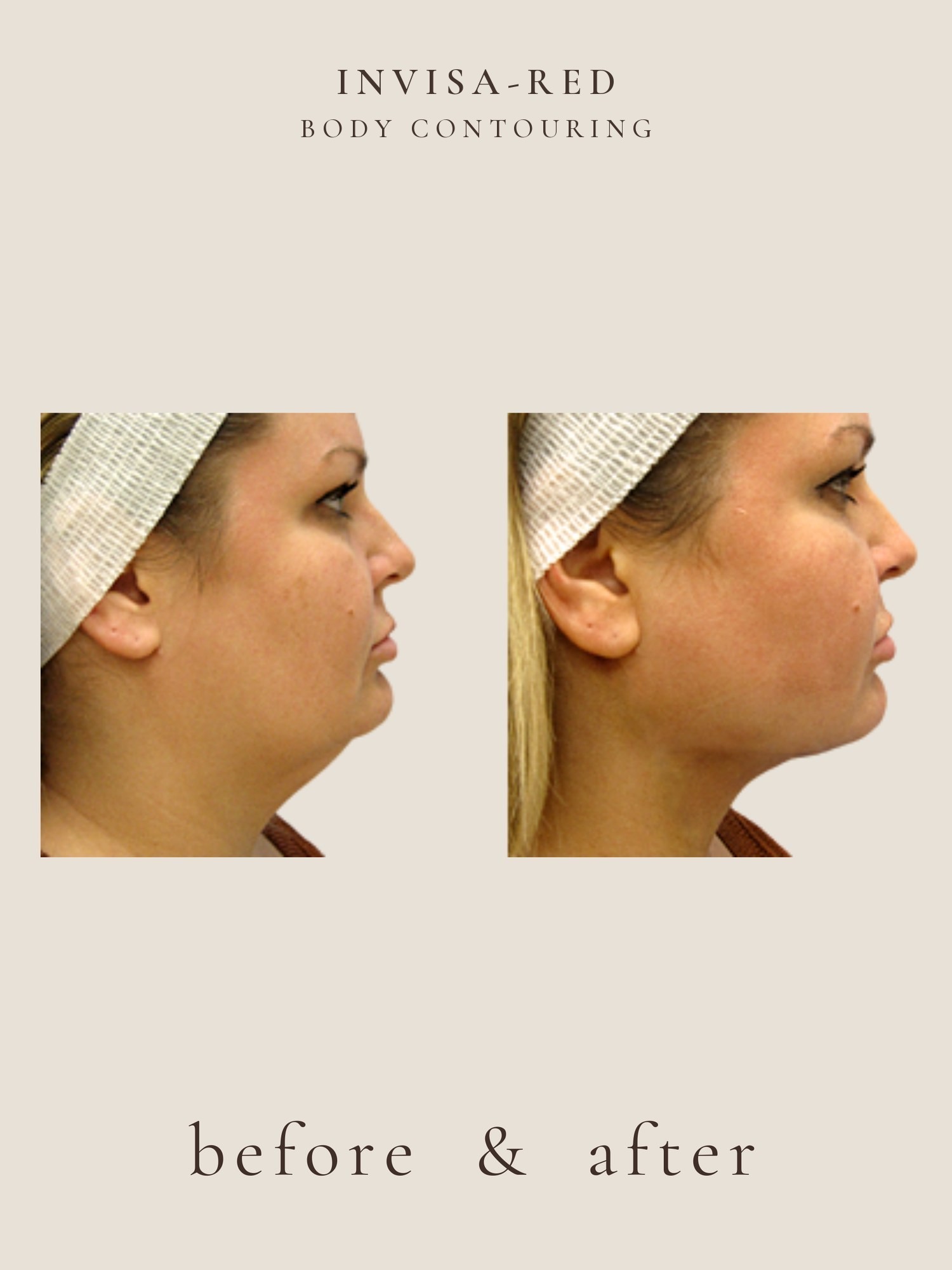 Fat Loss — Light & Laser