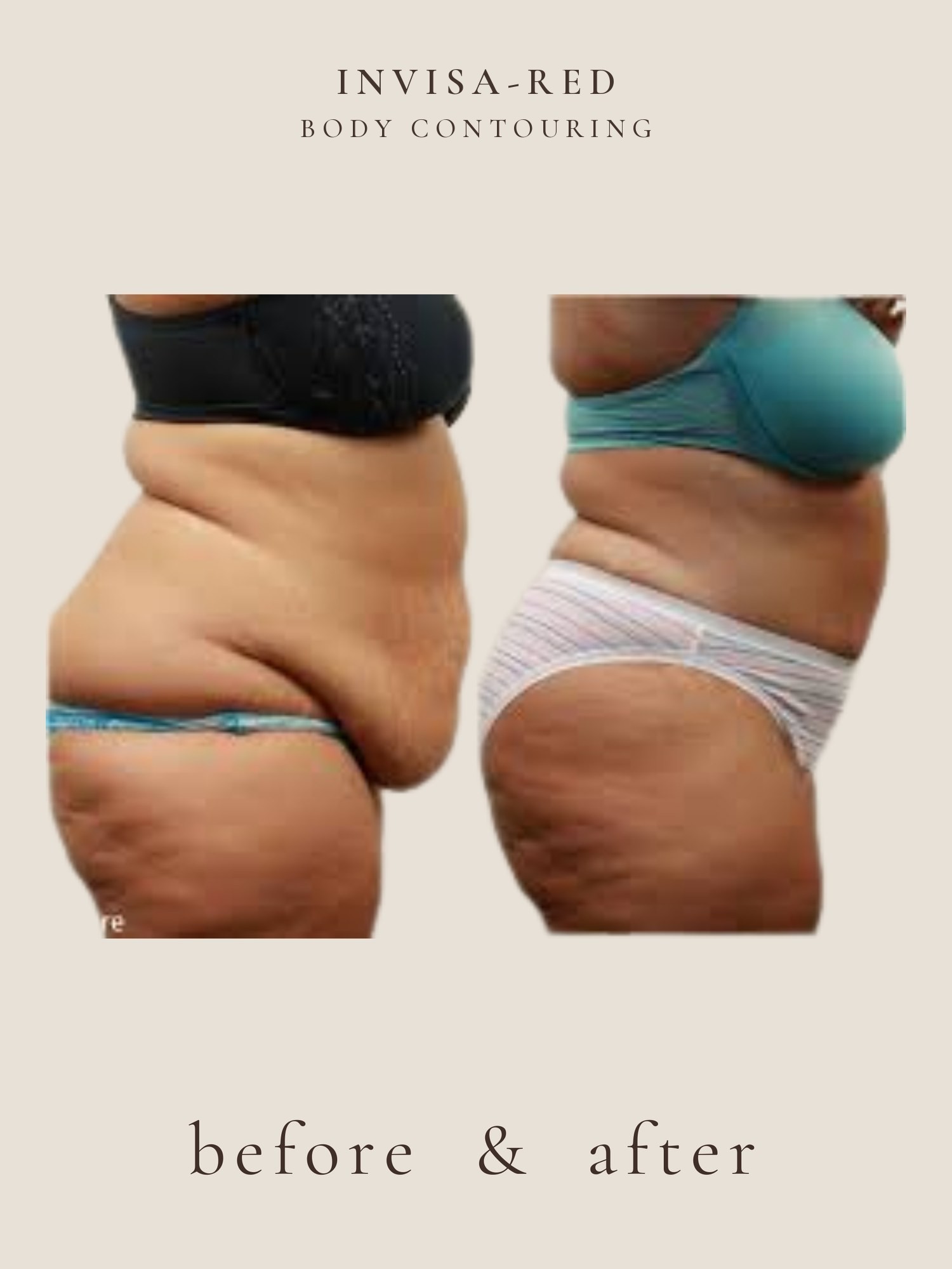 Fat Loss — Light & Laser