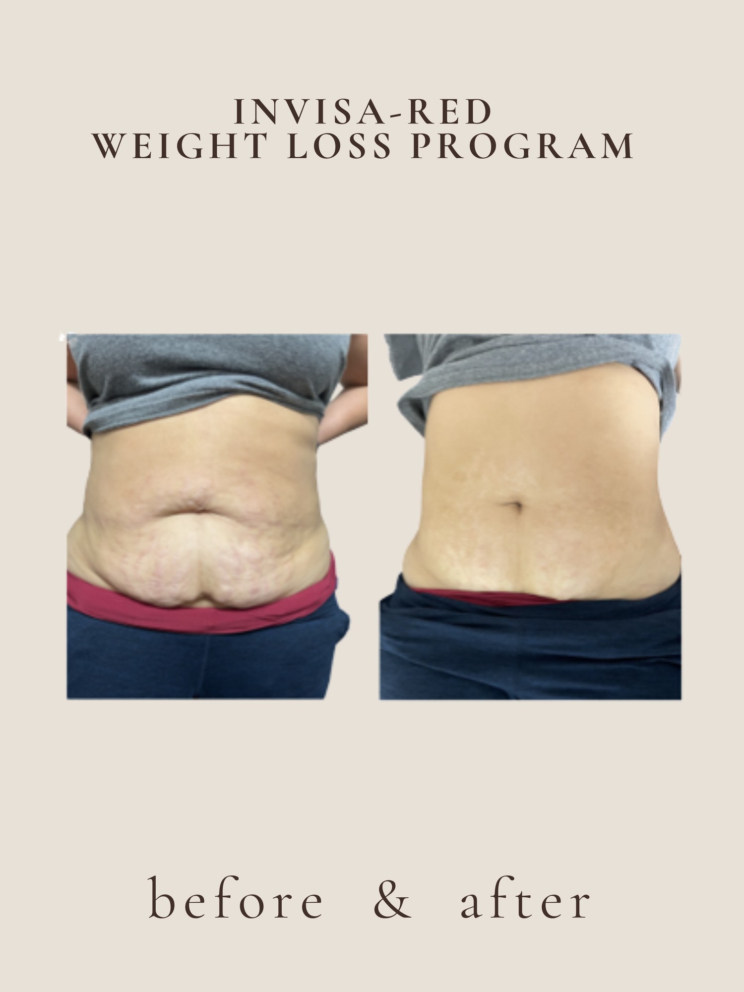 invisa-RED® fat reduction before and after