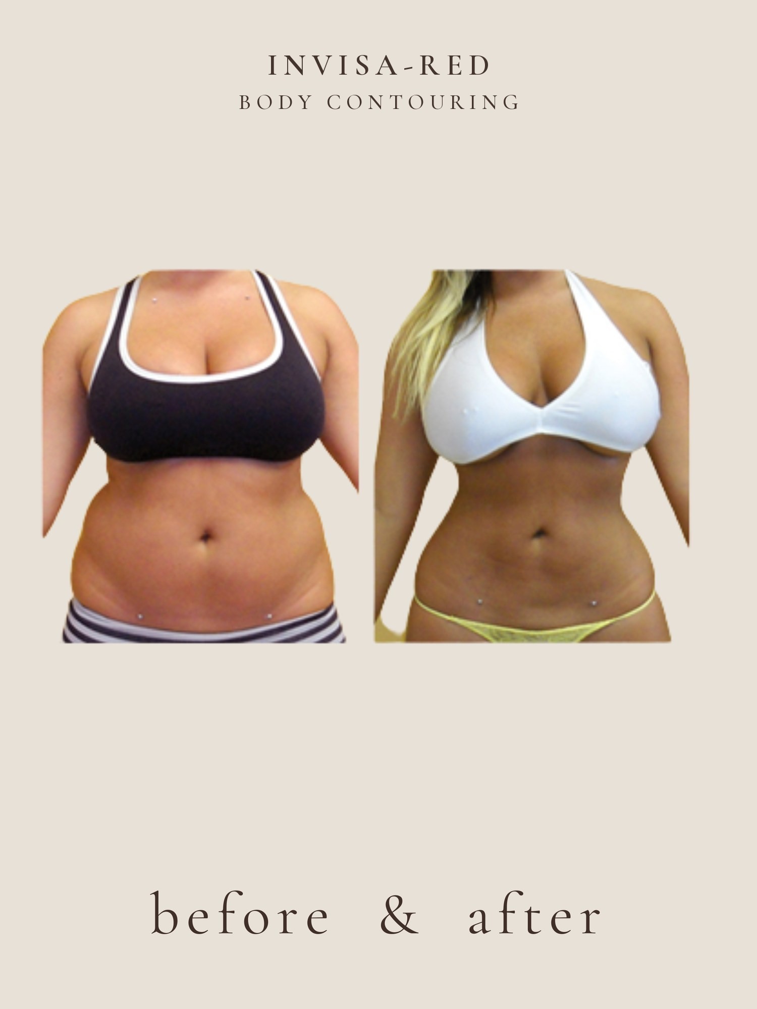 Fat Loss — Light & Laser
