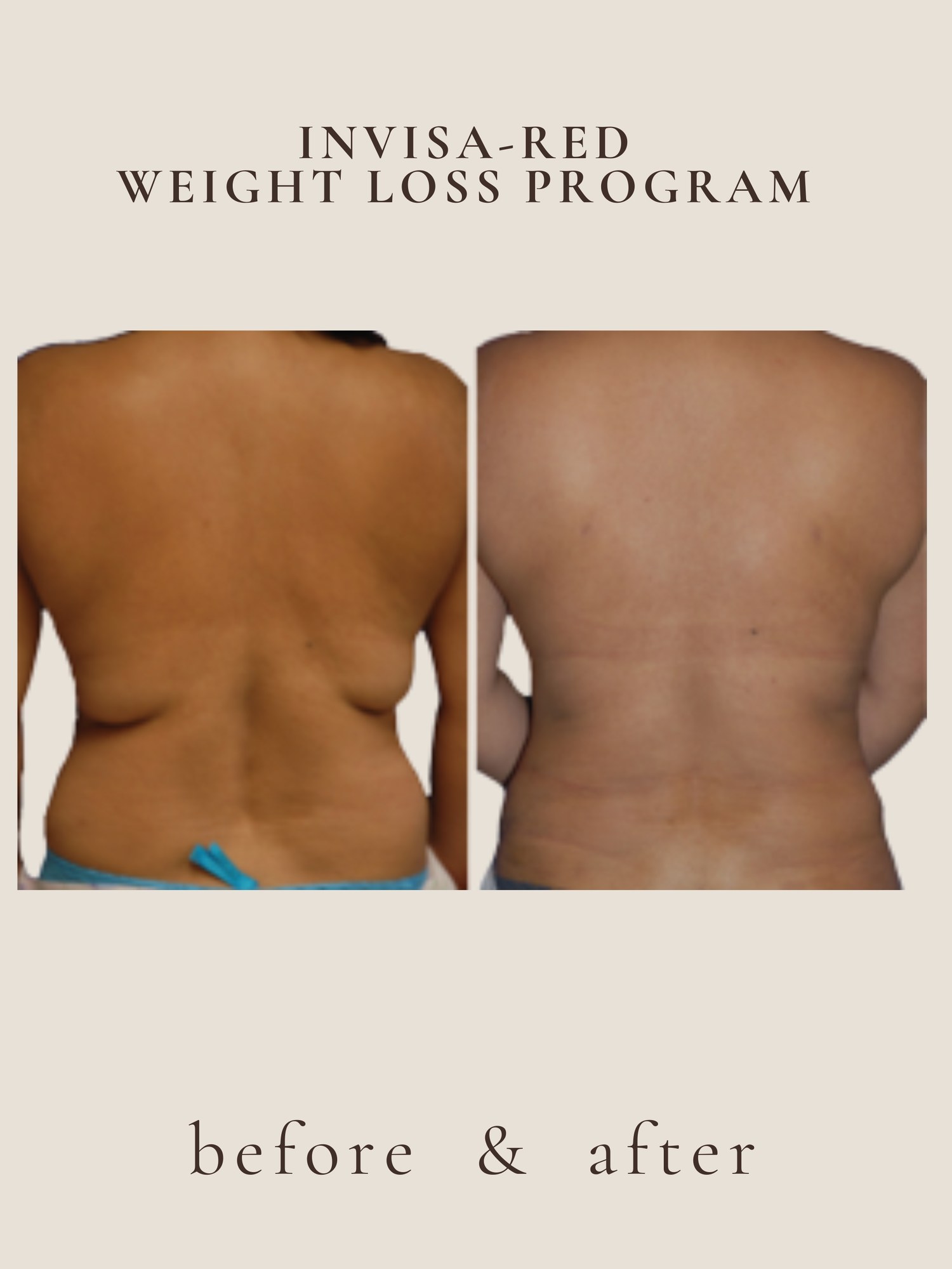 invisa-RED® fat reduction before and after