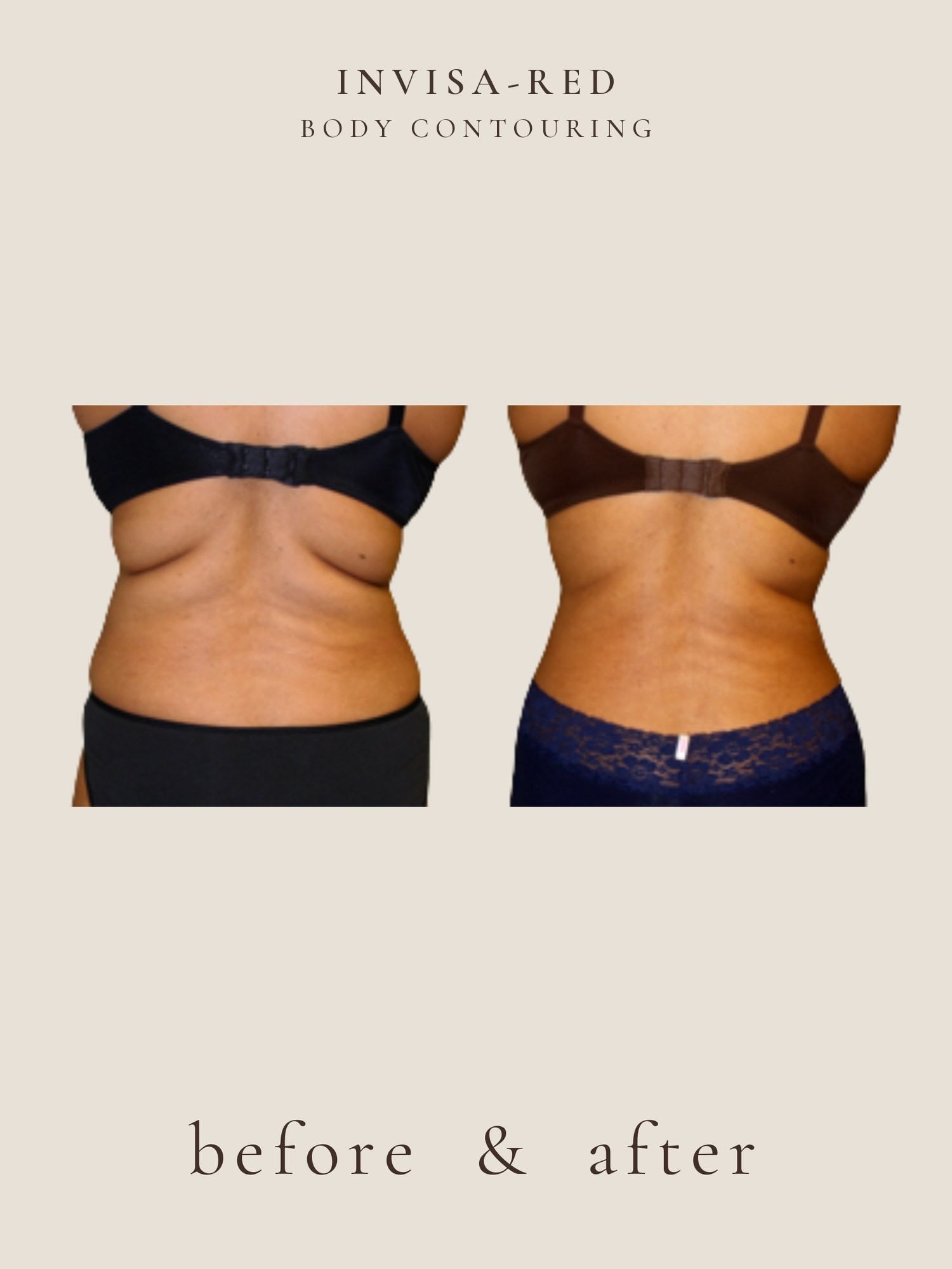 Fat Loss — Light & Laser