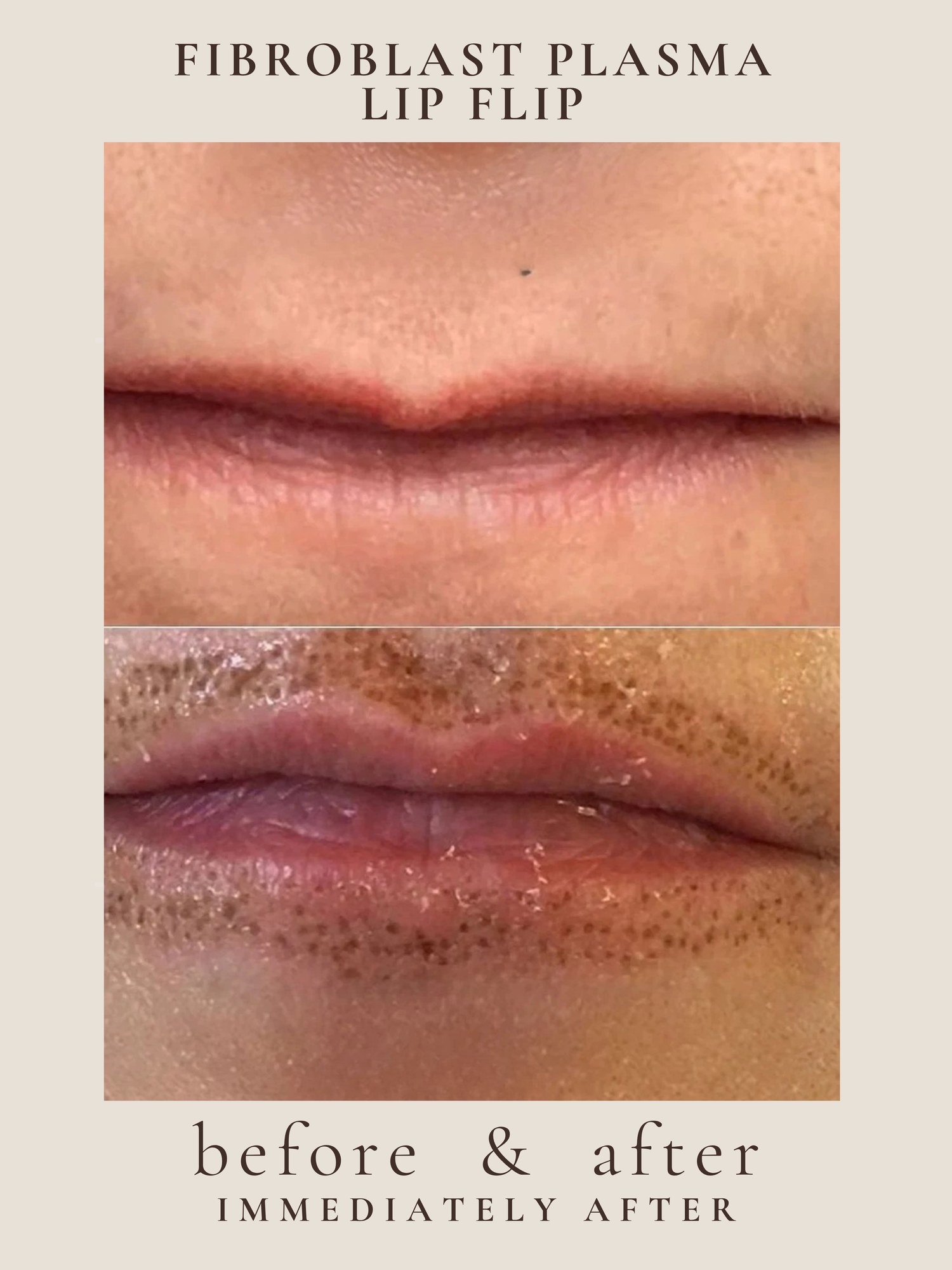 Lip Lift — Fibroblast Plasma · Lip Flip