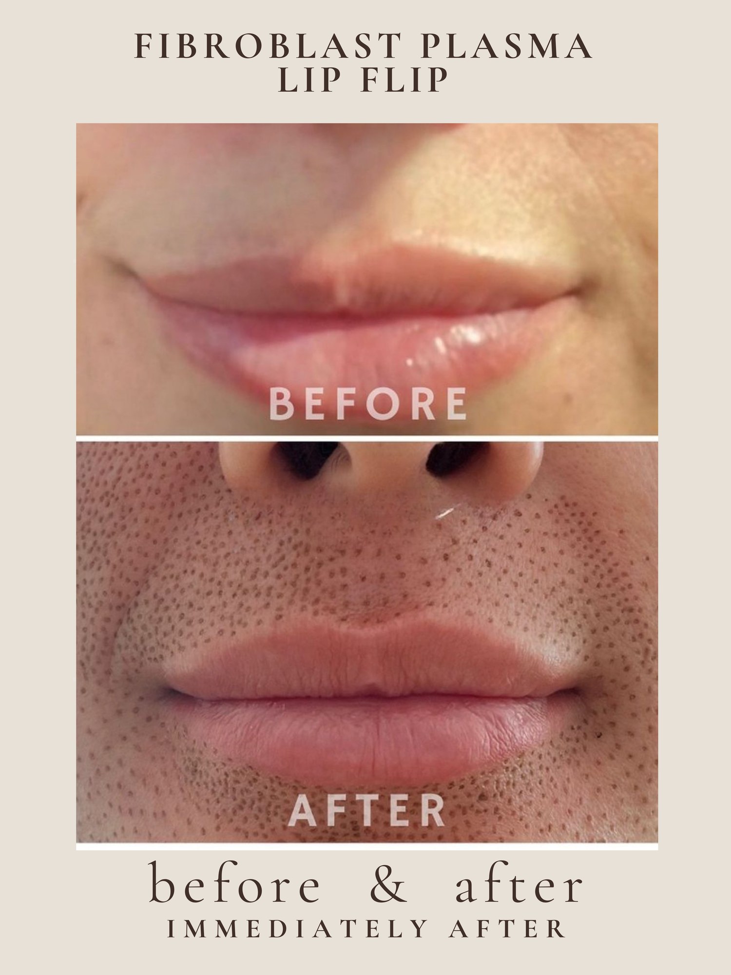 Lip Lift — Fibroblast Plasma · Lip Flip