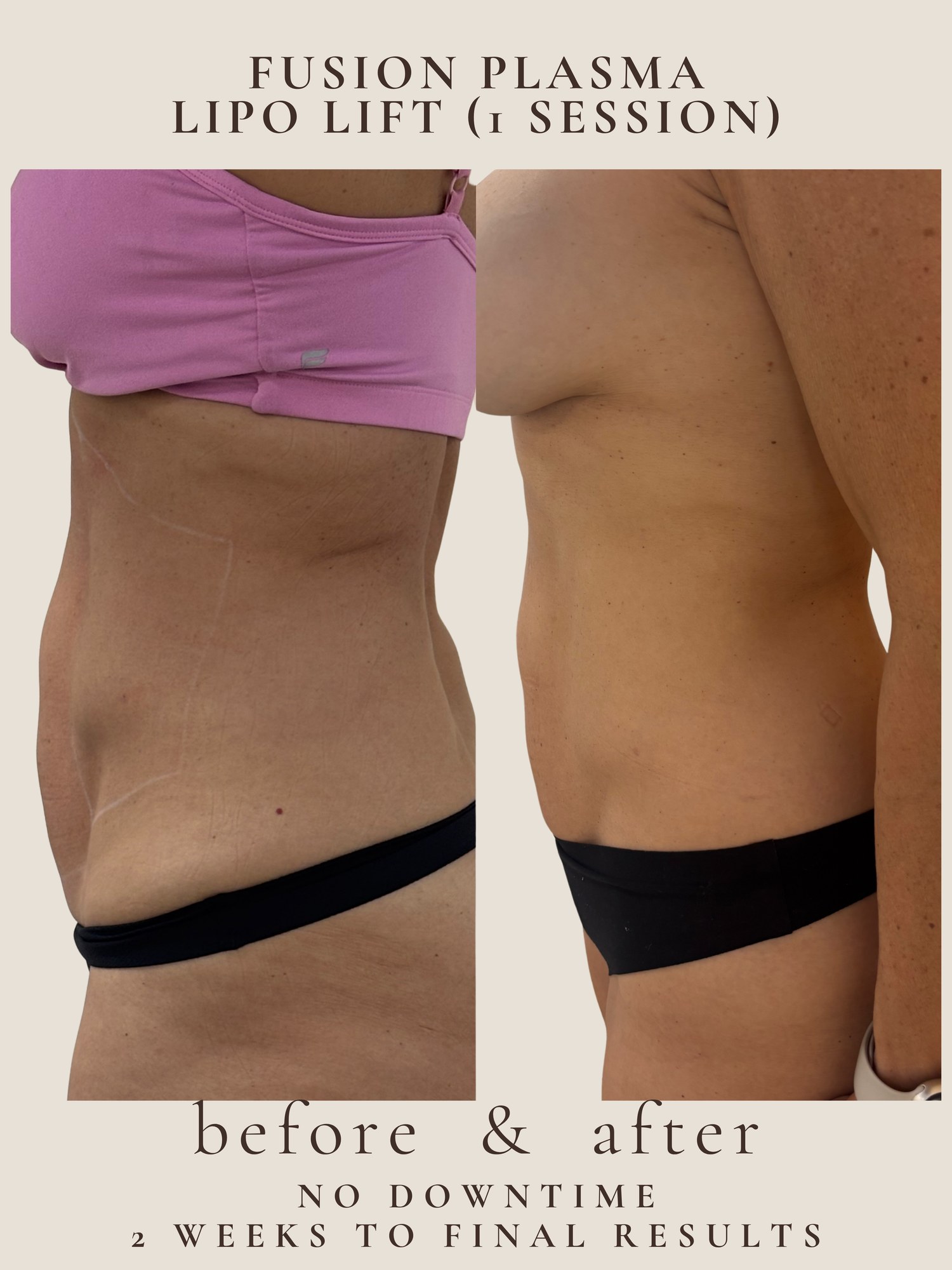 Before and after Fusion Plasma Lipo Lift