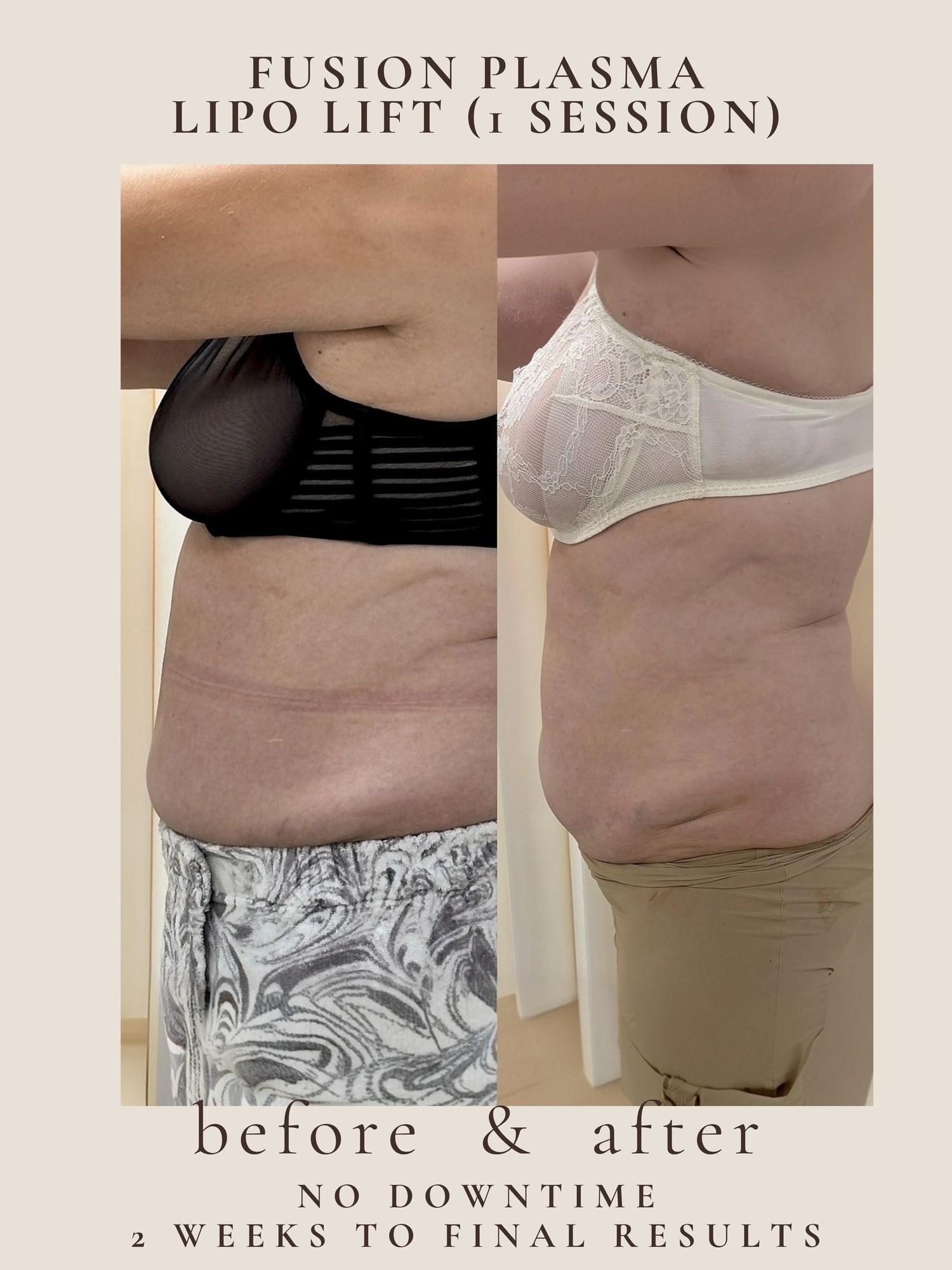 Lipo Lift — Fusion Plasma · 1 session