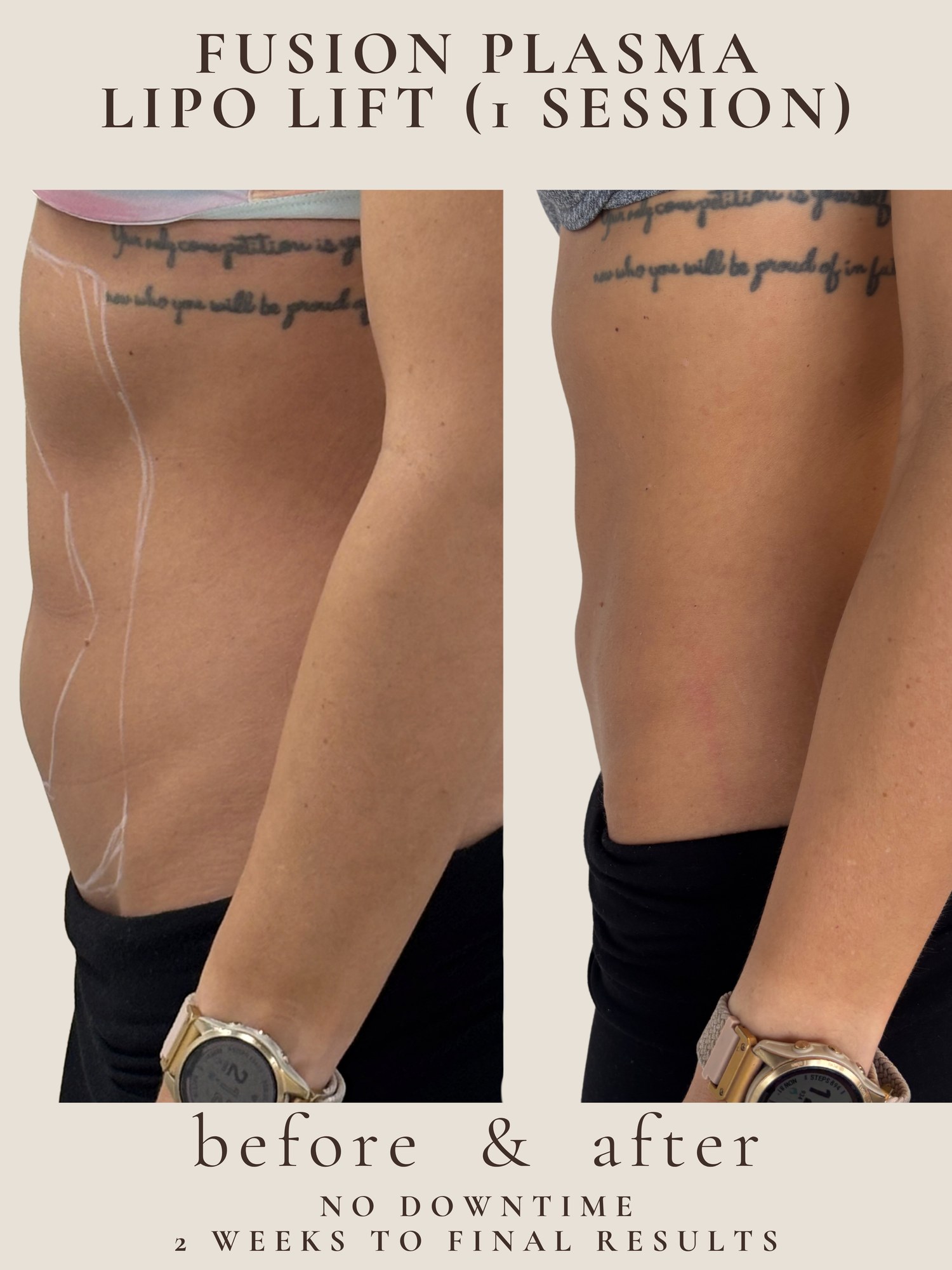 Fusion Plasma Lipo Lift before and after