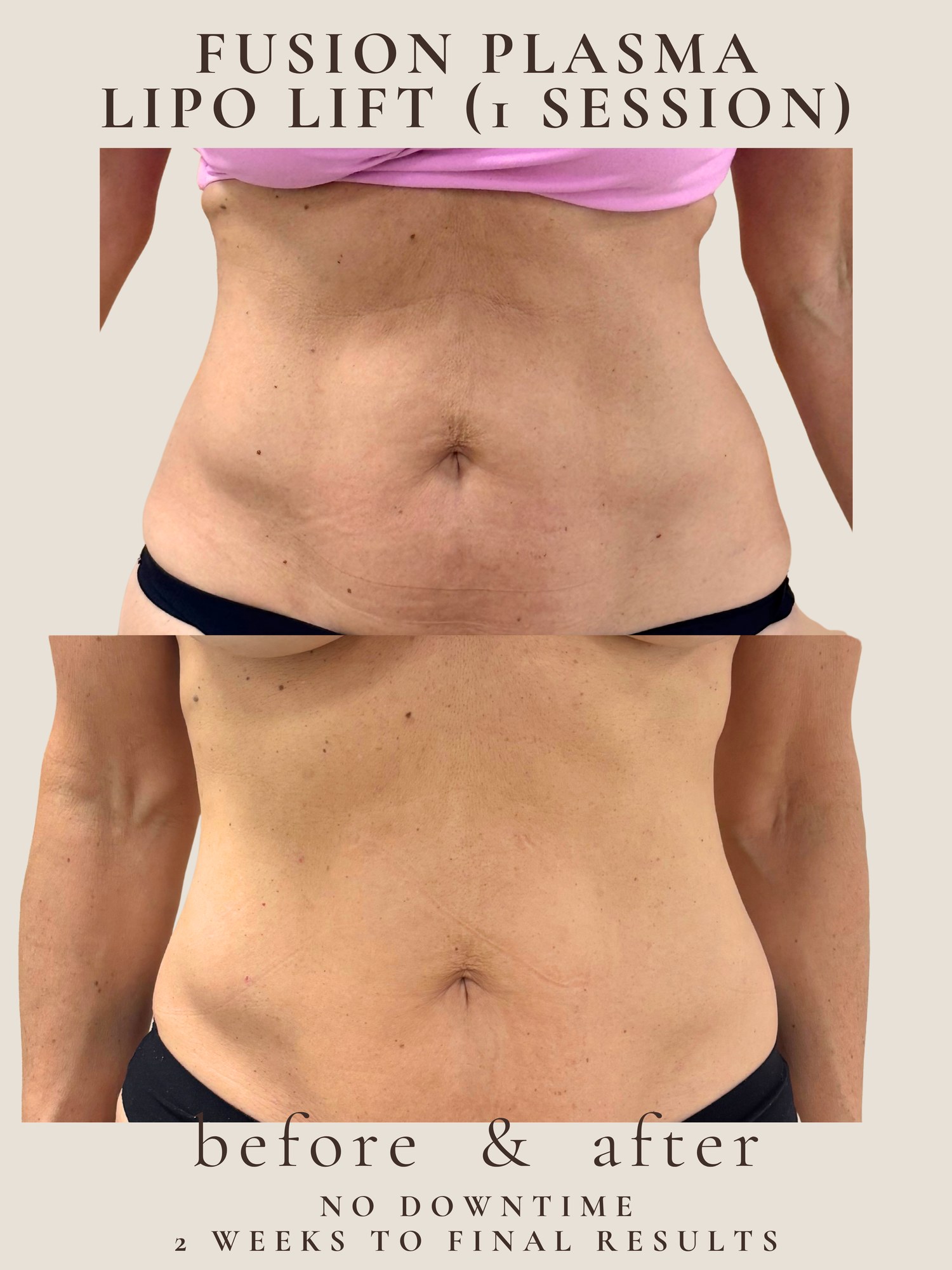 Lipo Lift — Fusion Plasma · 1 session