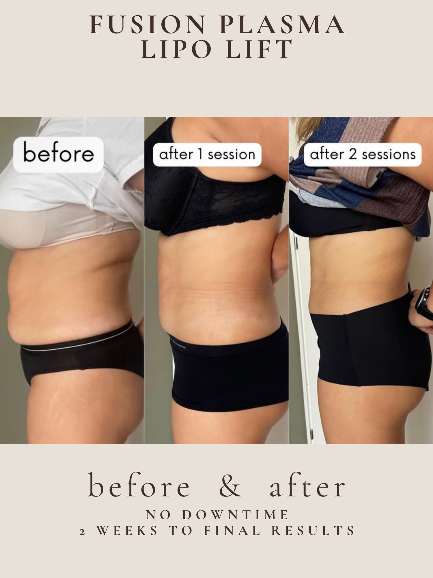 Fusion Plasma Lipo Lift before and after