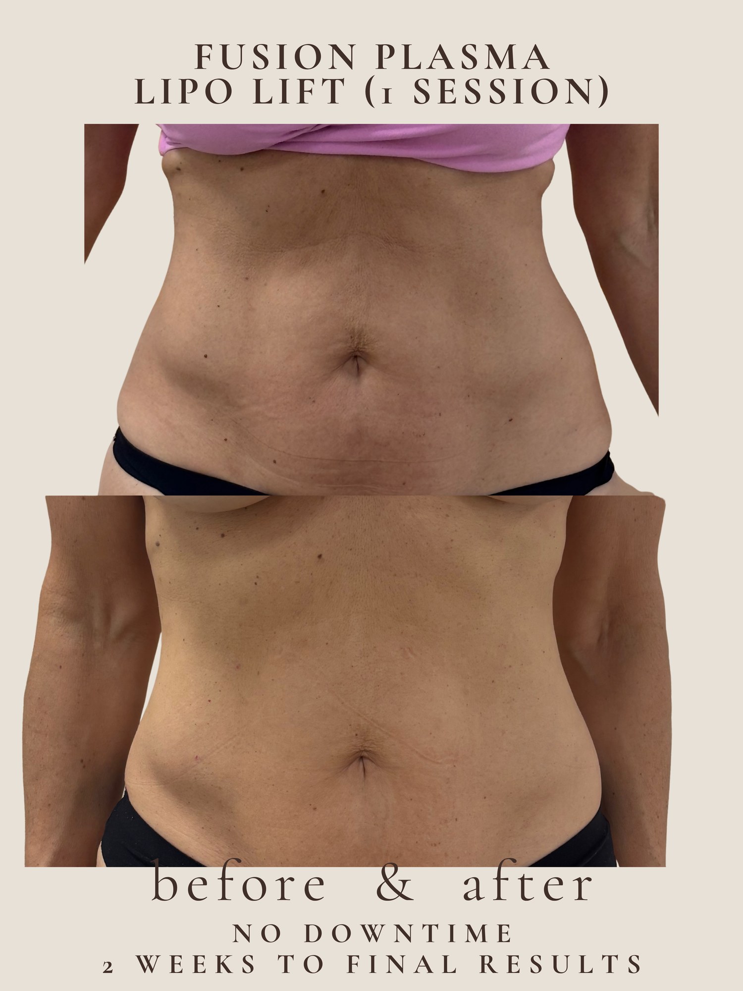Lipo Lift — Fusion Plasma · 1 session