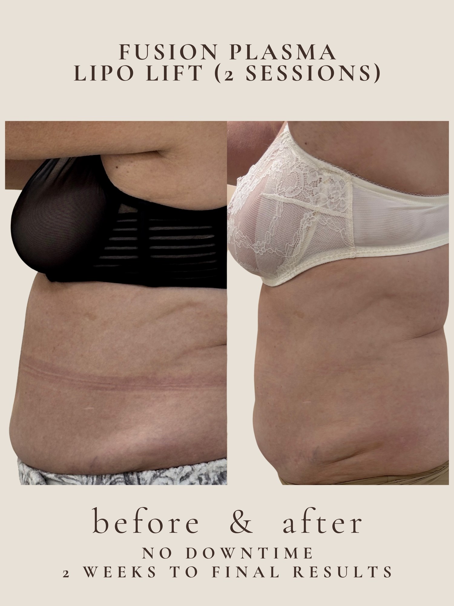 Fusion Plasma Lipo Lift before and after — 2 sessions