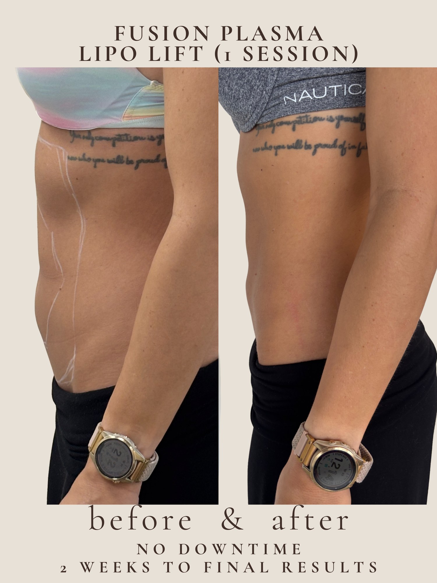 Lipo Lift — Fusion Plasma · 1 session