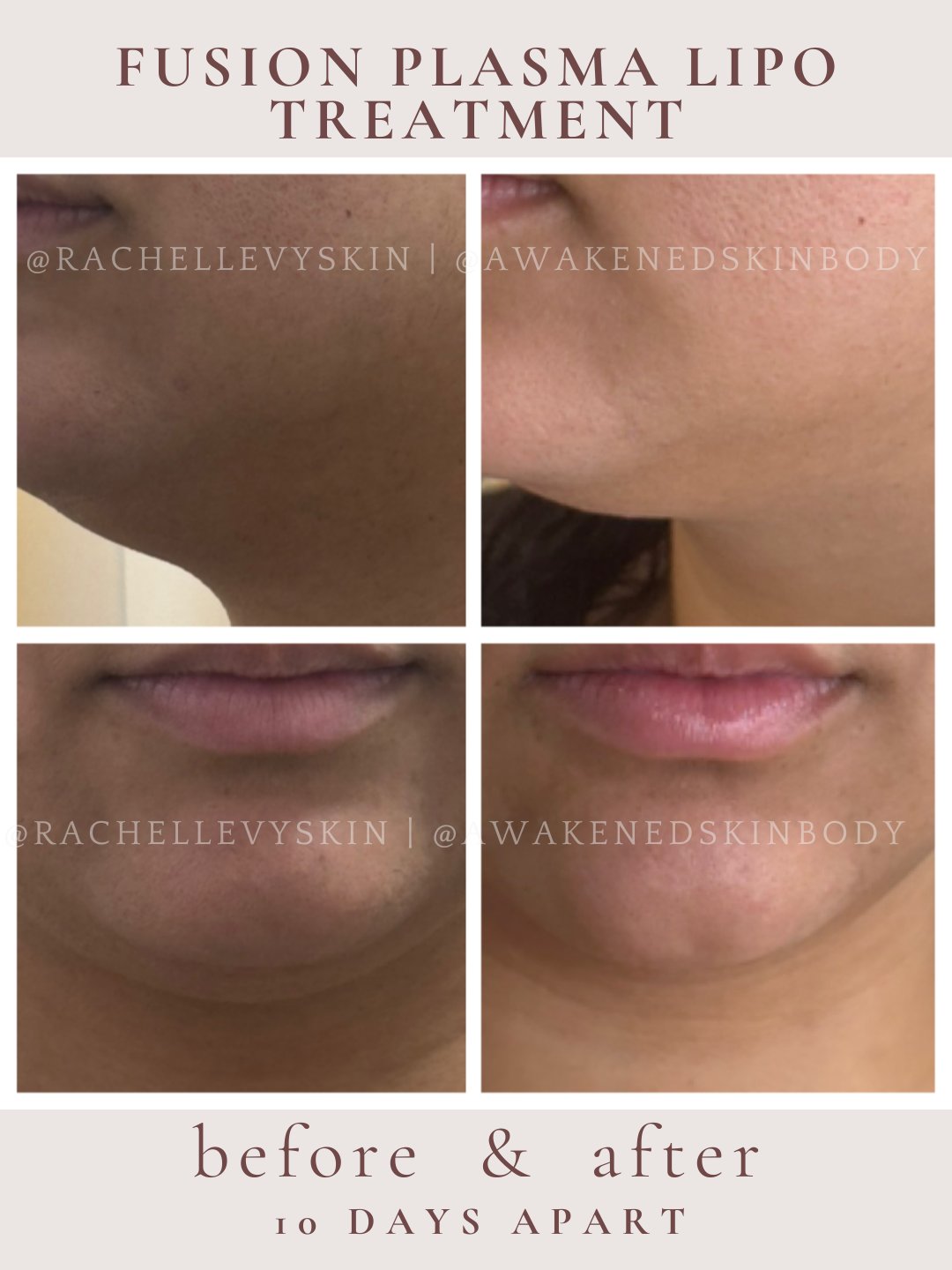 Chin and jawline contour before and after, 10 days apart