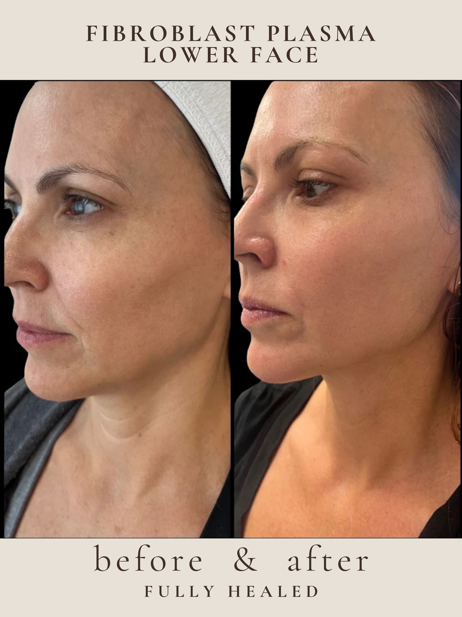 Lower Face — Fibroblast Plasma