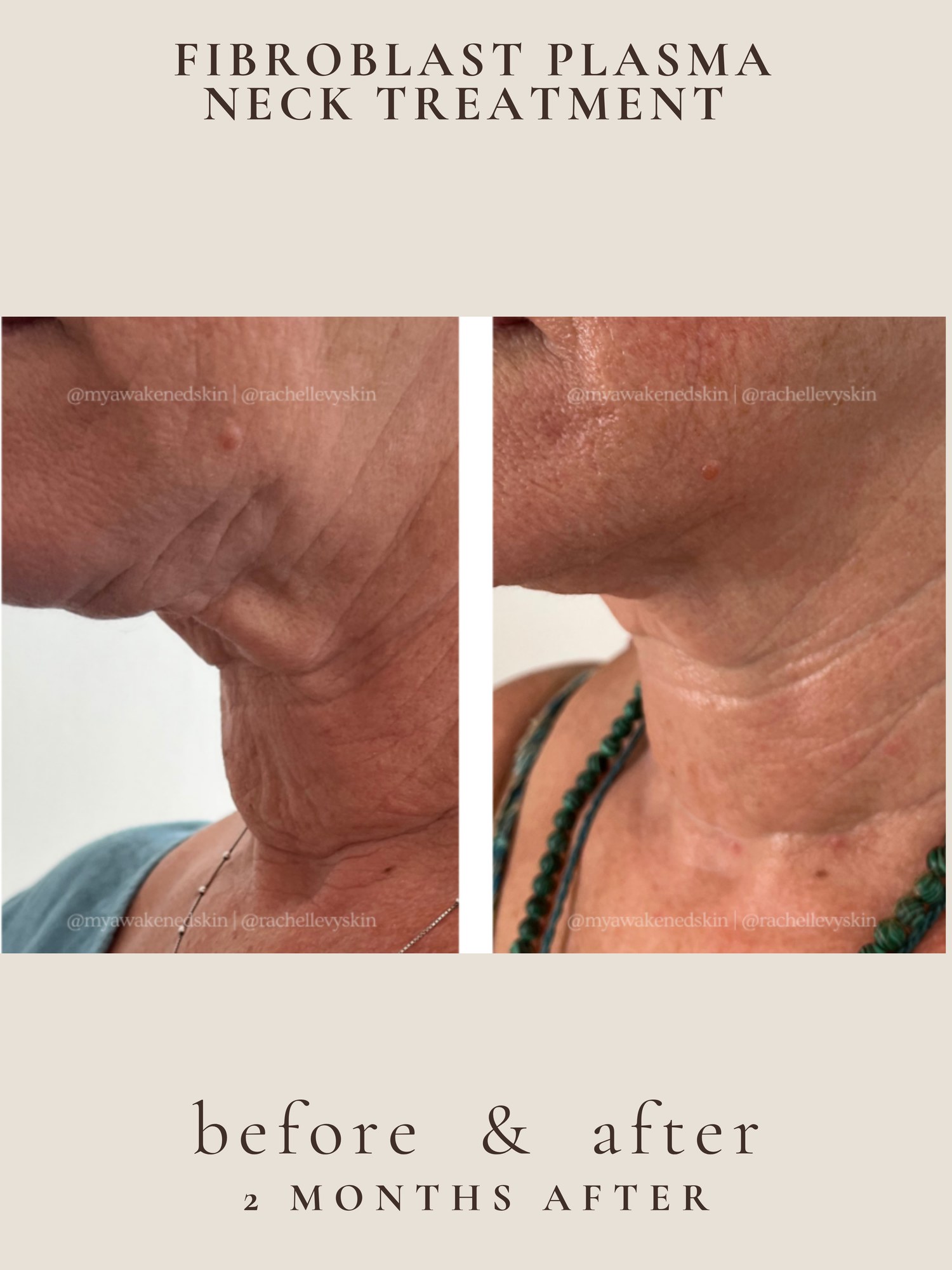 Neck tightening before and after
