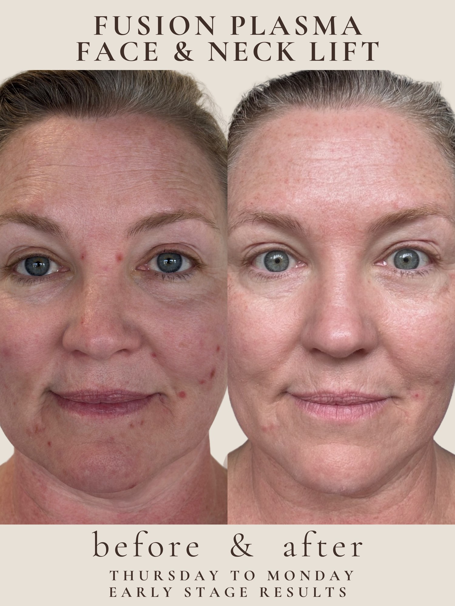 Neck Lift — Fibroblast Plasma