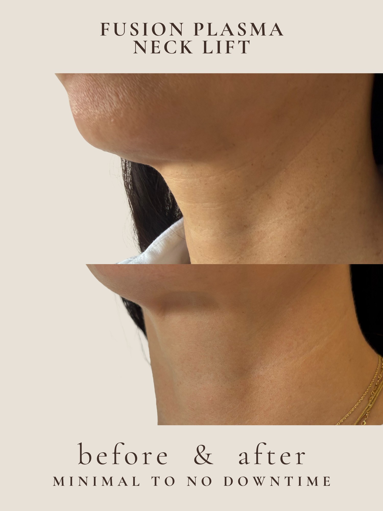Neck Lift — Fusion Plasma