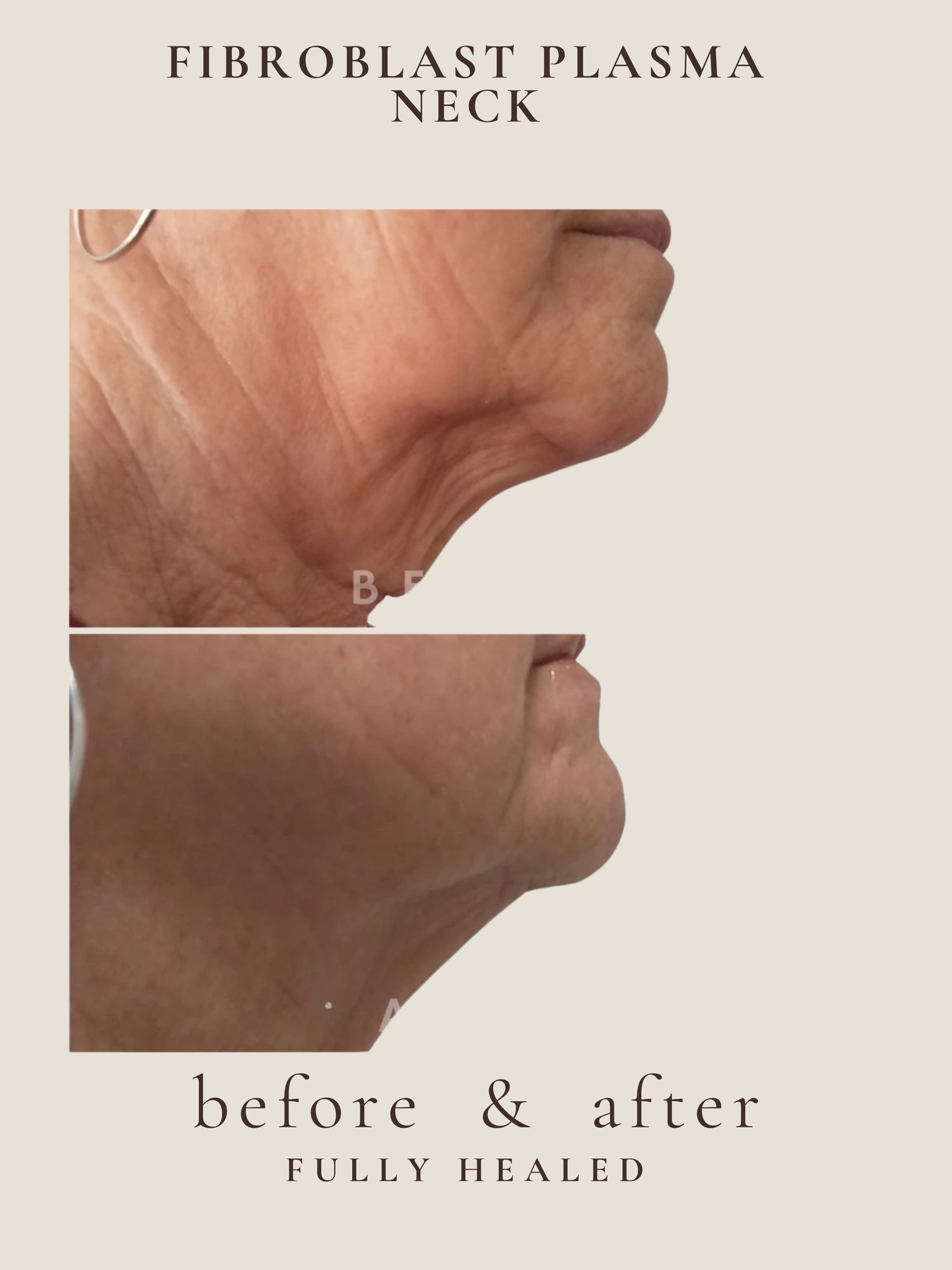 Neck Lift — Fibroblast Plasma