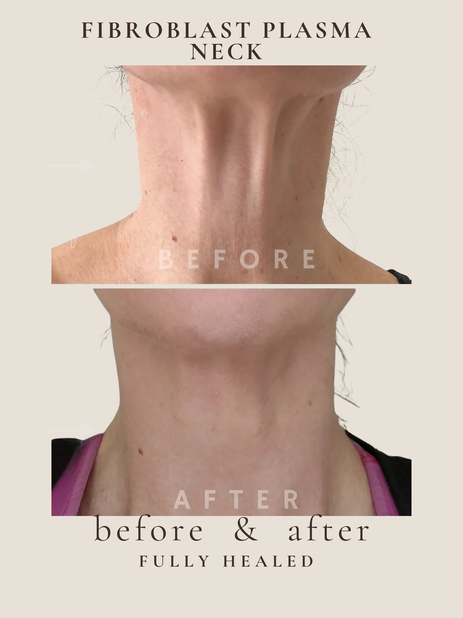 Neck Lift — Fibroblast Plasma