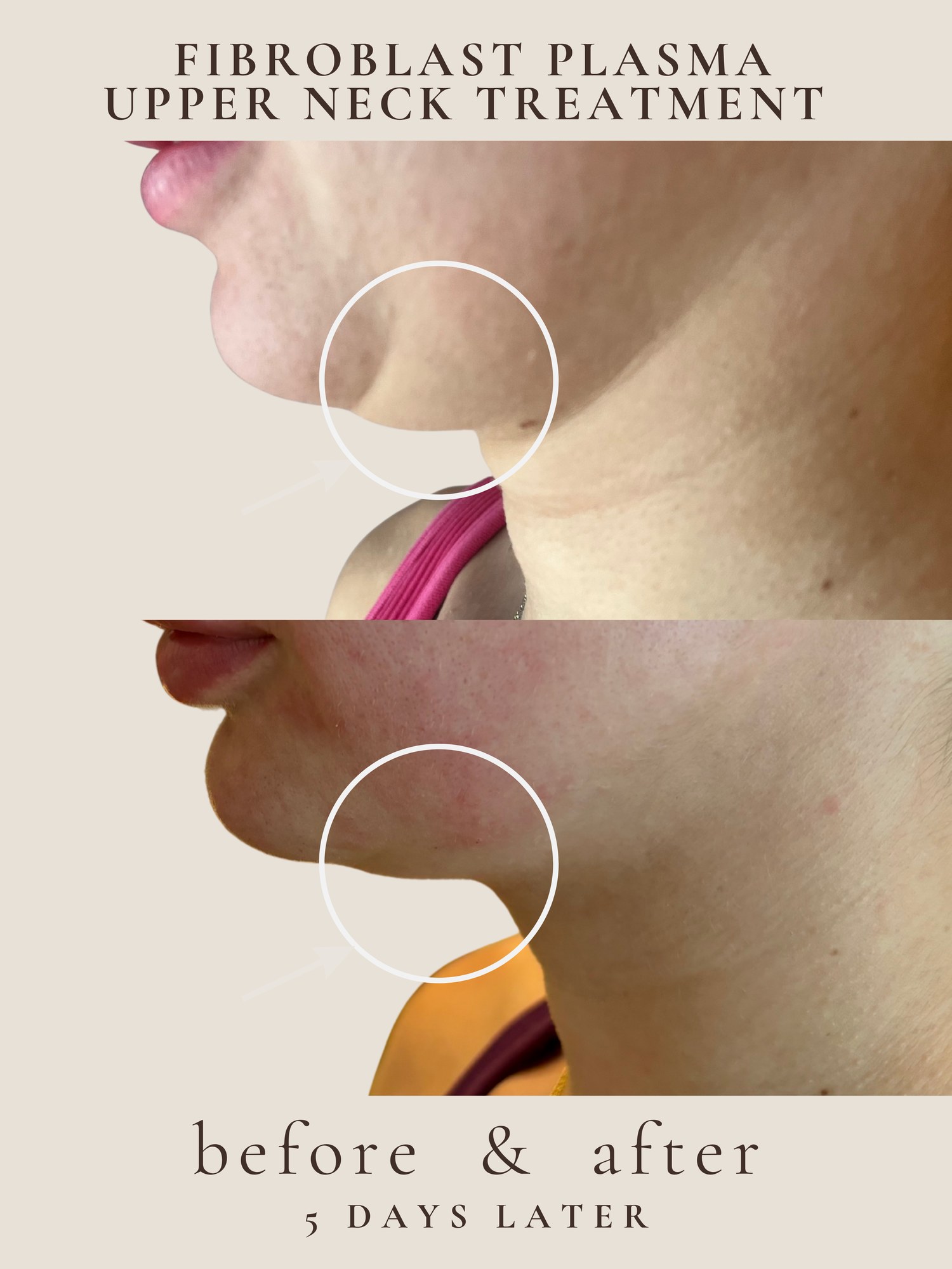 Upper Neck — Fibroblast Plasma