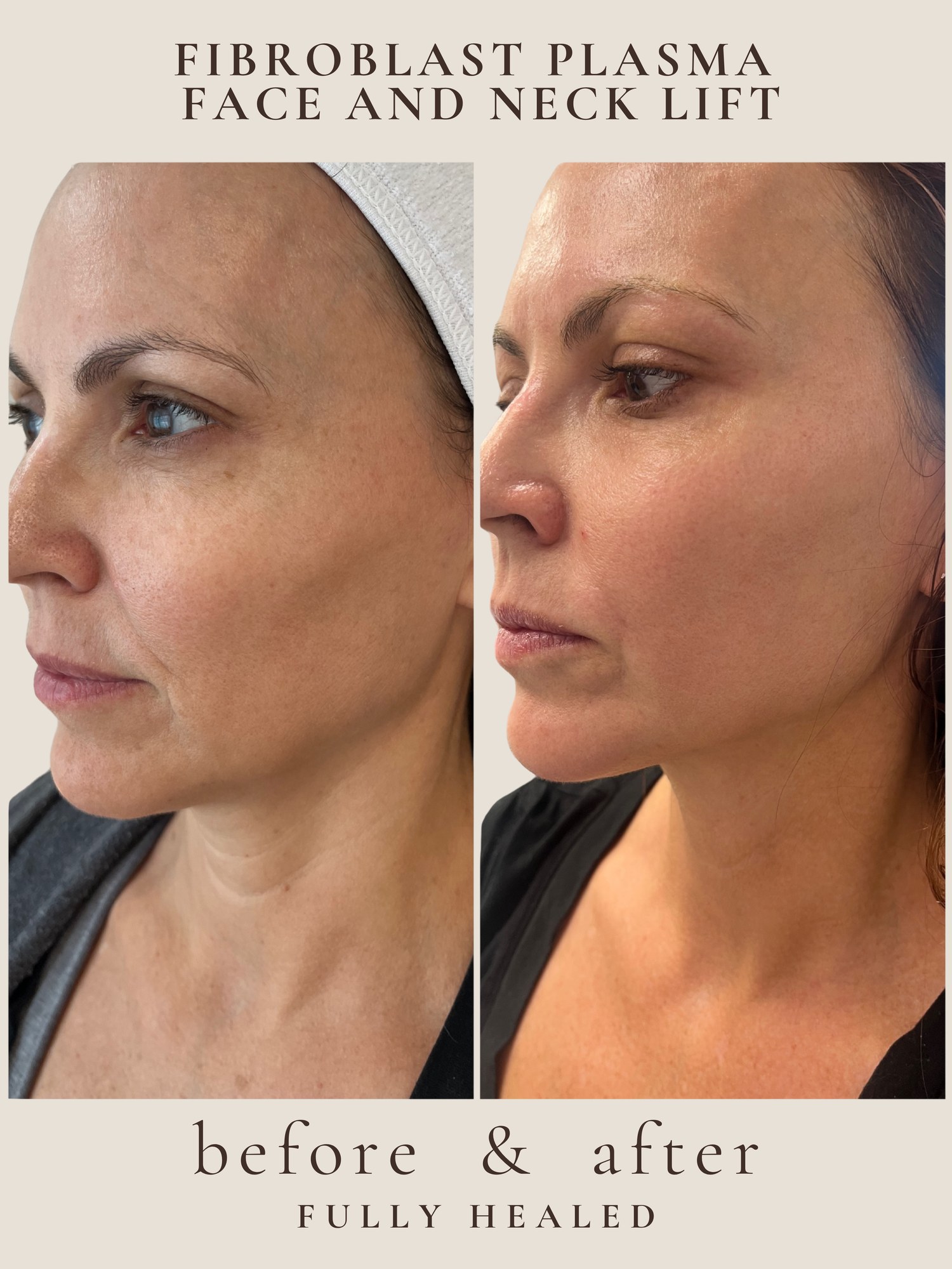 Face & Neck Lift — Fibroblast Plasma