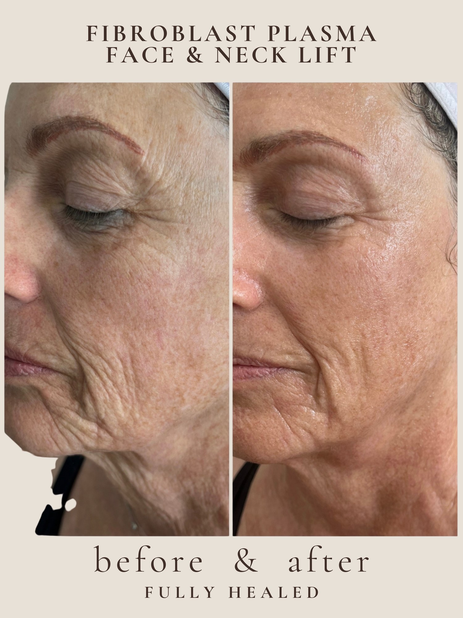 Face & Neck Lift — Fibroblast Plasma